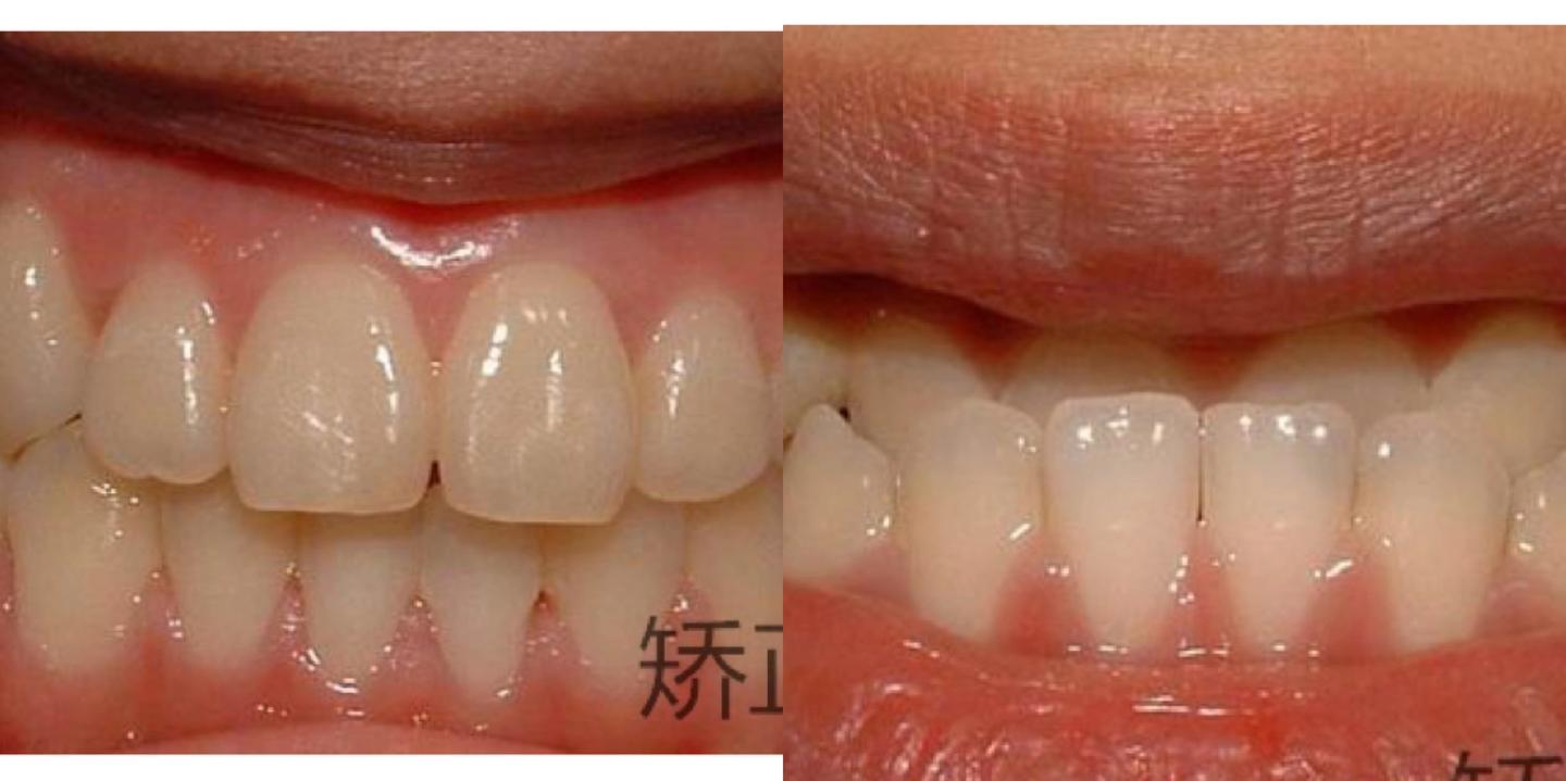 郑州牙齿出现地包天的原因是什么