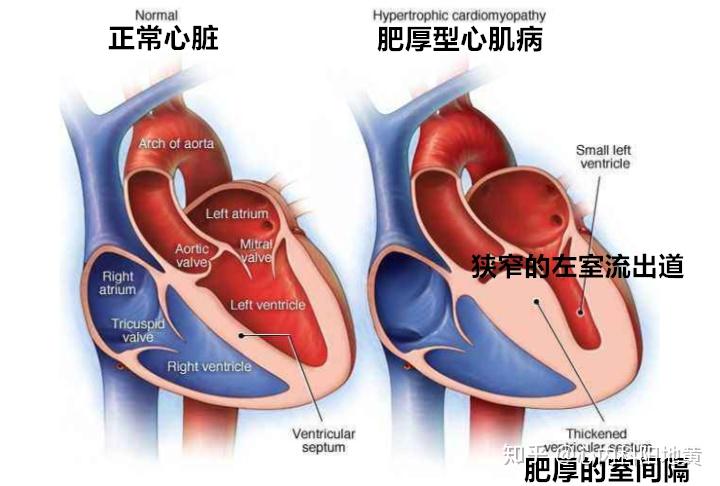 主动脉瓣狭窄和先天性主动脉瓣下隔膜引起的左心室壁增厚[1]