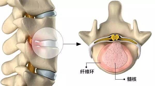 正确认识椎间盘的退变原理如何修复受损的纤维环椎间