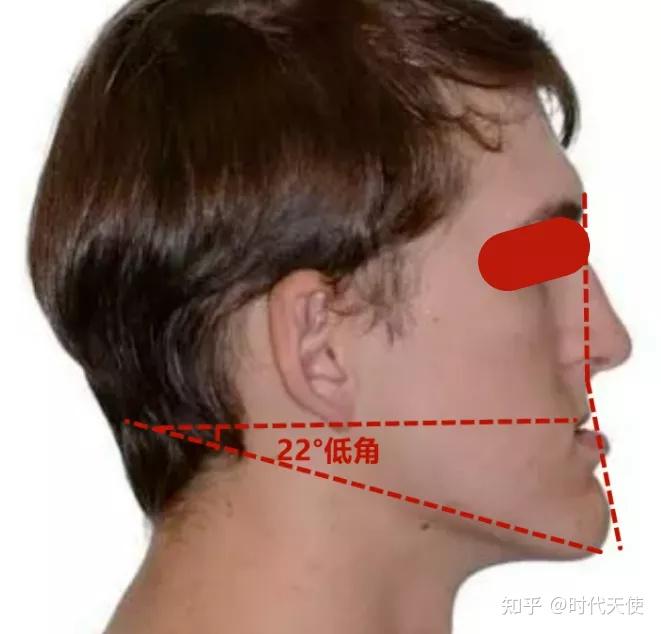 外观:眶下区和鼻旁区低平,鼻唇沟比较深,面型呈凹面型,下巴颏特别长