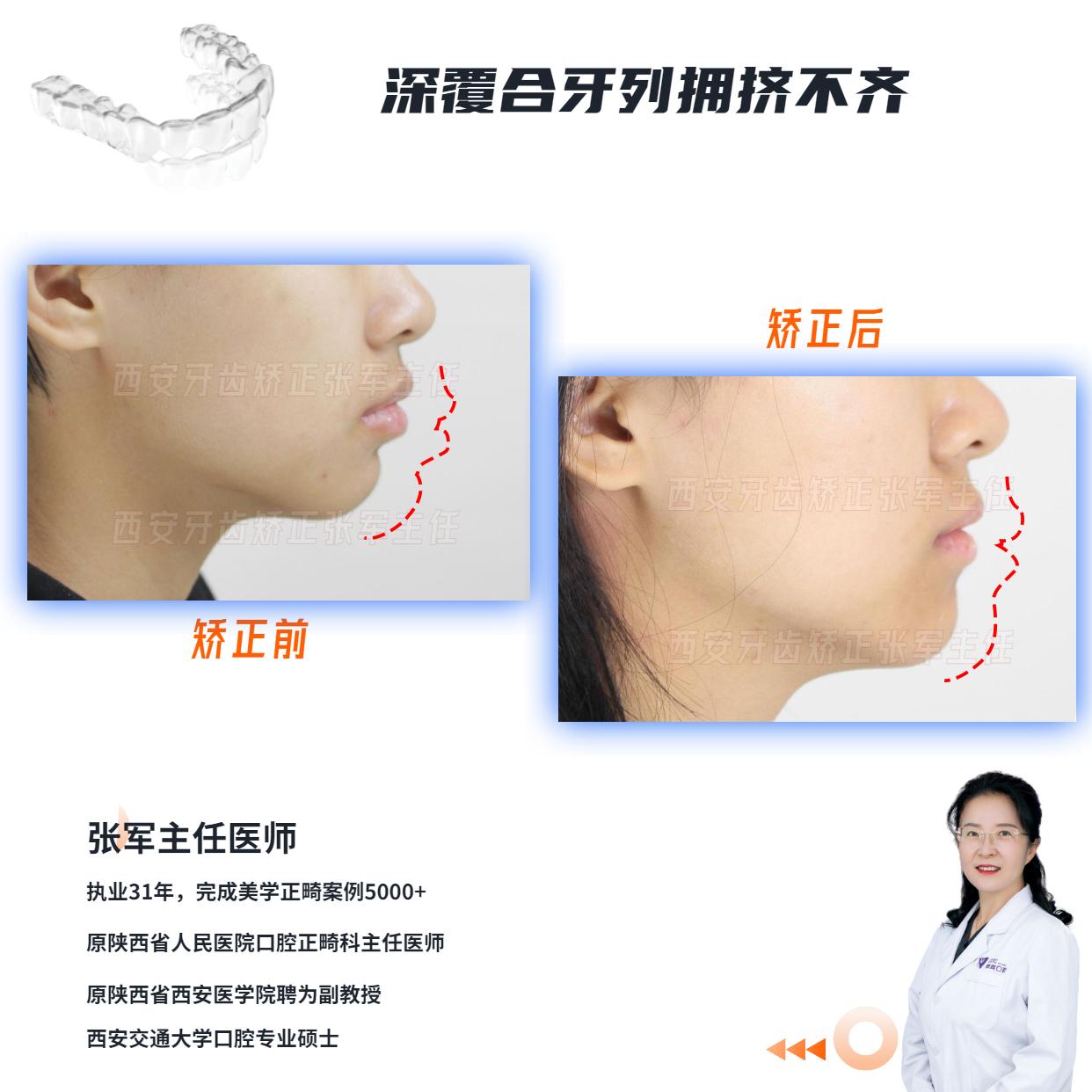 西安牙齿矫正深覆合矫正能改变脸型吗