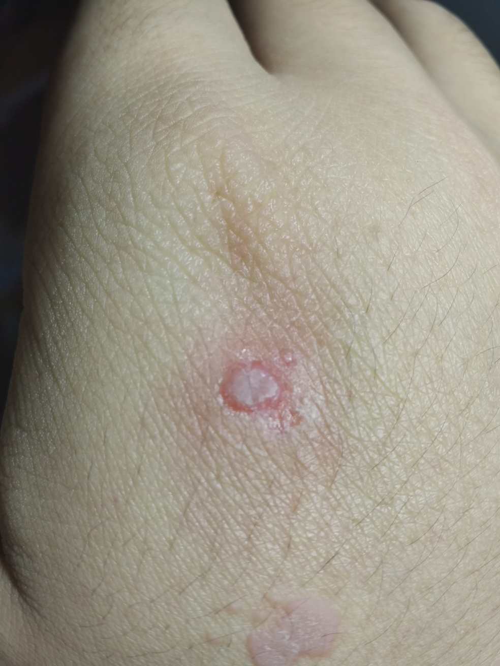 手背上,这个东西是扁平疣吗,我该怎么办? - 知乎