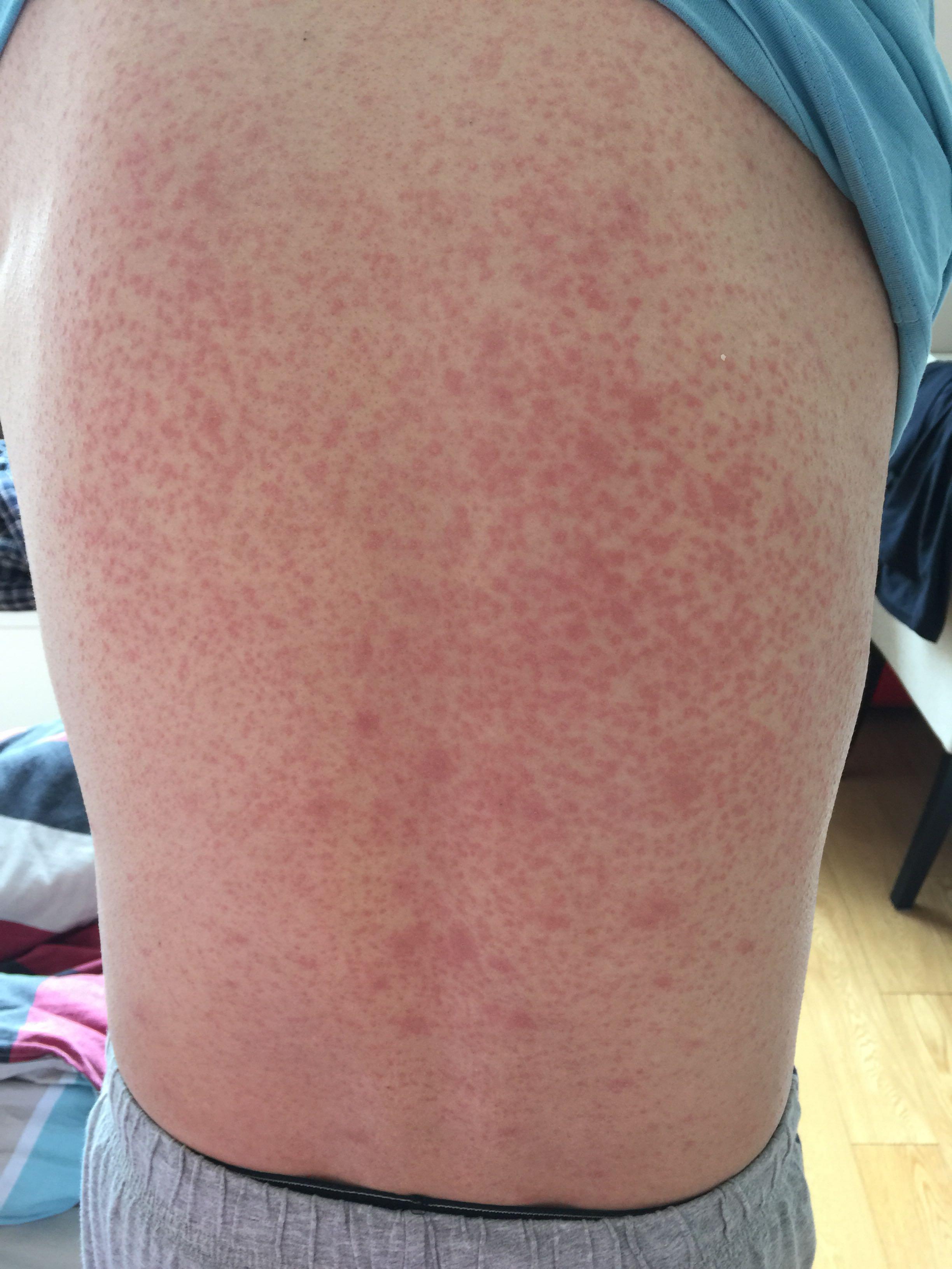 得了玫瑰糠疹怎么办