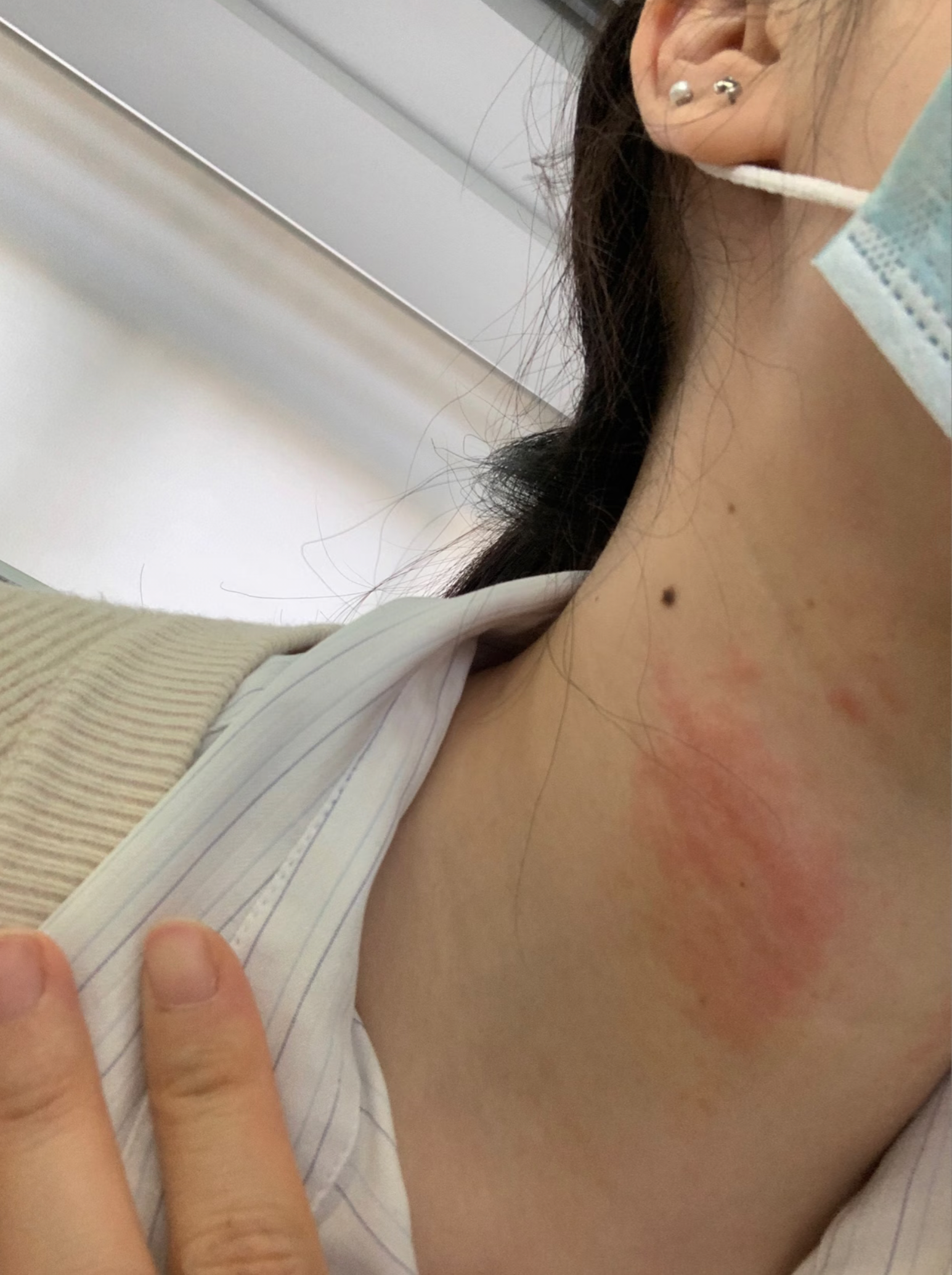 湿疹为什么一热就出来 湿疹为什么一热就出来