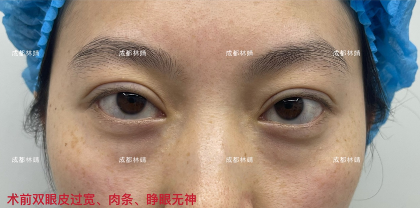 双眼皮形态有很大关系双眼皮宽眼球显凸就会有目光呆滞之感参考悲伤蛙