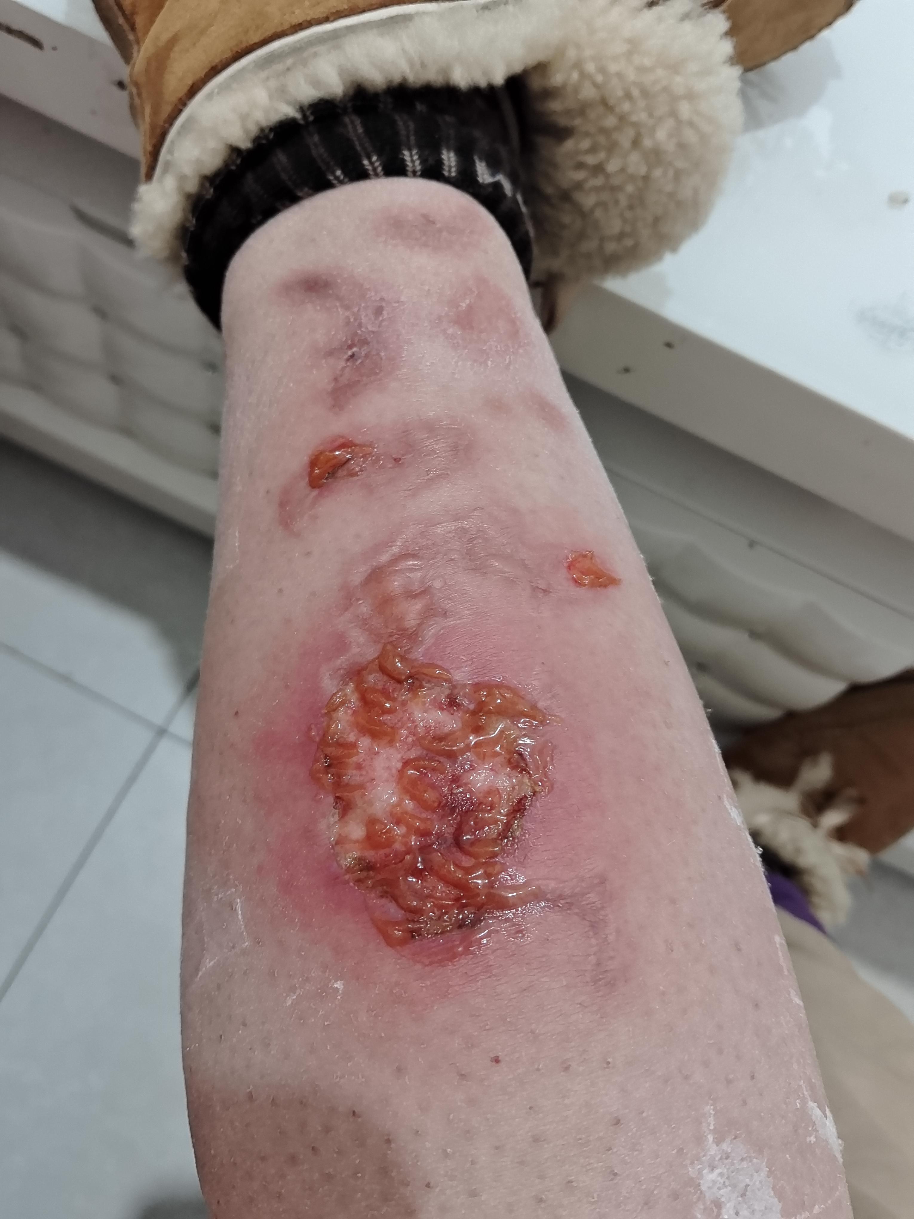 举世无双 的想法: 腿被热水袋烫伤的痊愈过程