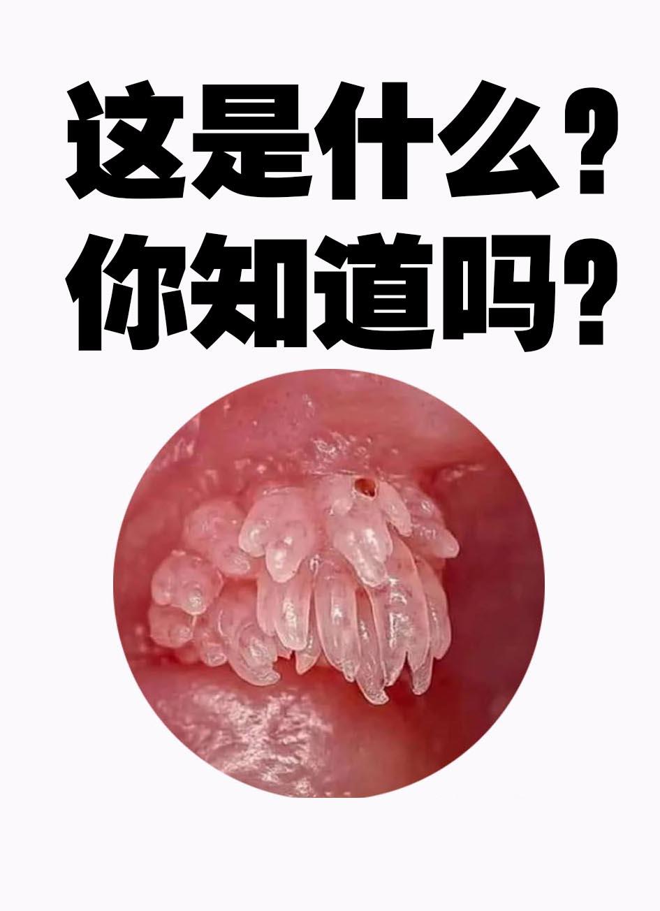 皮肤科董主任 的想法: 女性尖锐湿疣的症状表现