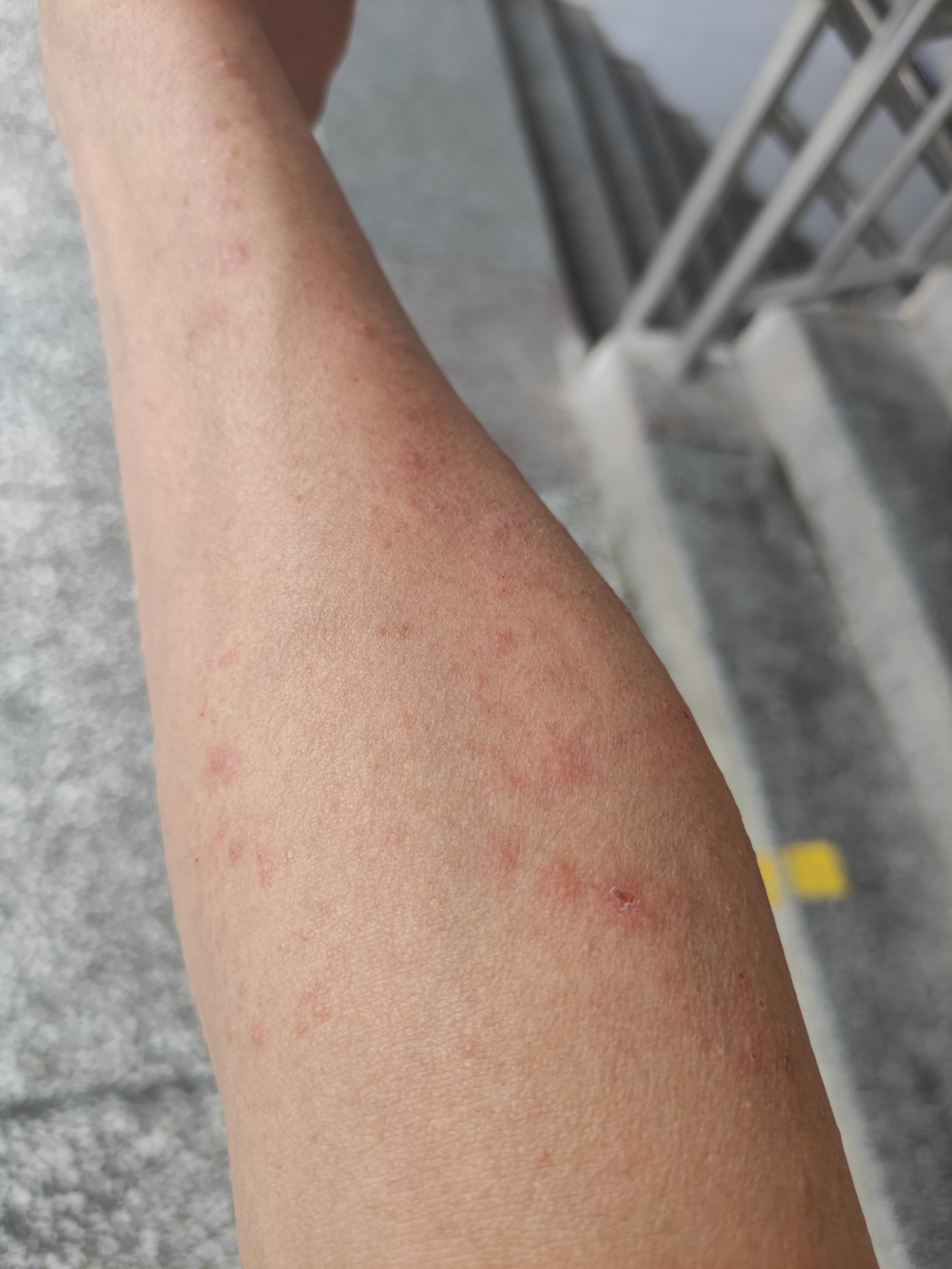 夏天手臂上突然起了很多像小水泡一样的疙瘩用手抓破了就是图片上红色
