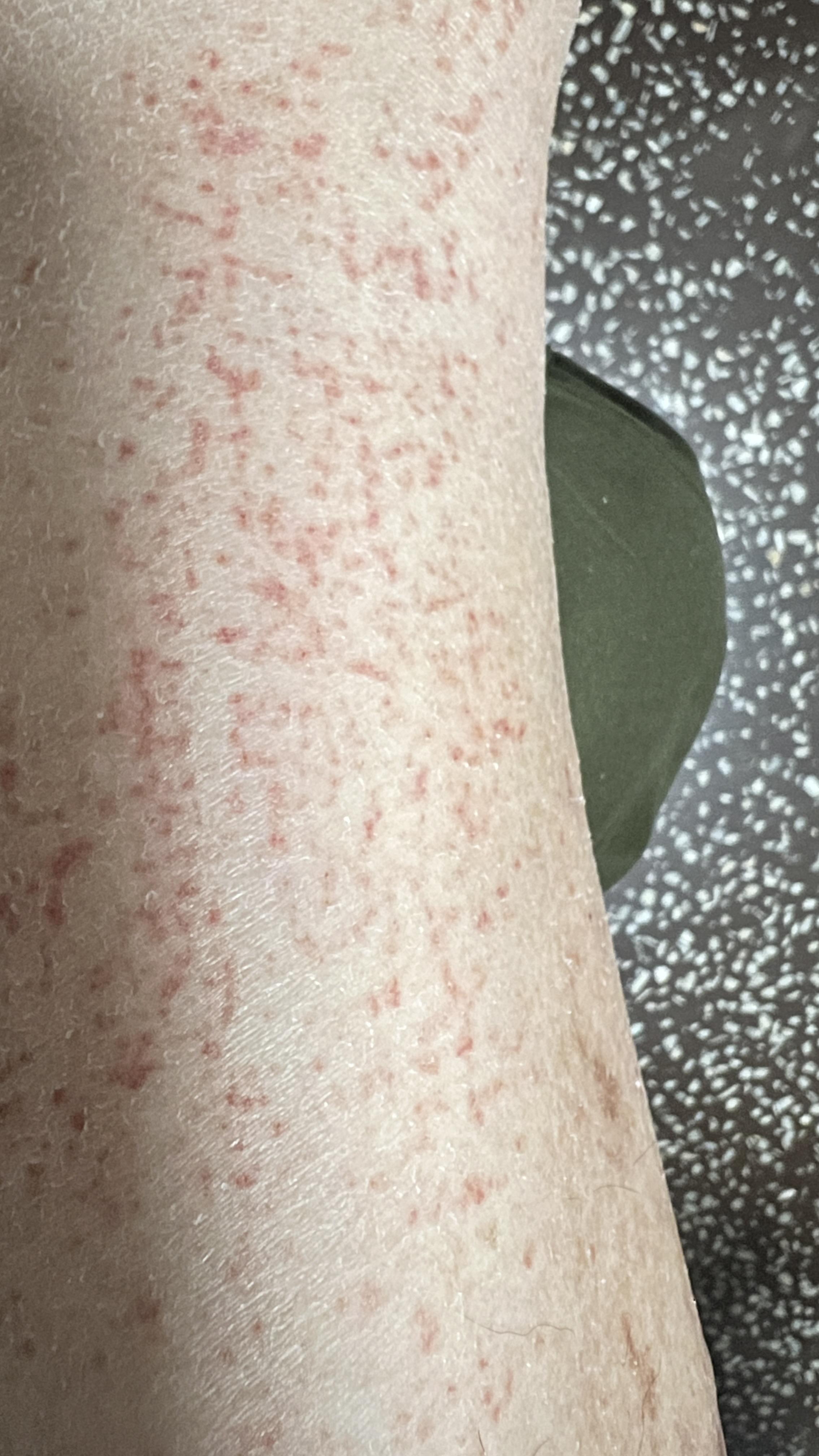 障碍特应性皮炎ad患者留不住表皮水分容易干燥脱屑并引起炎症和瘙痒