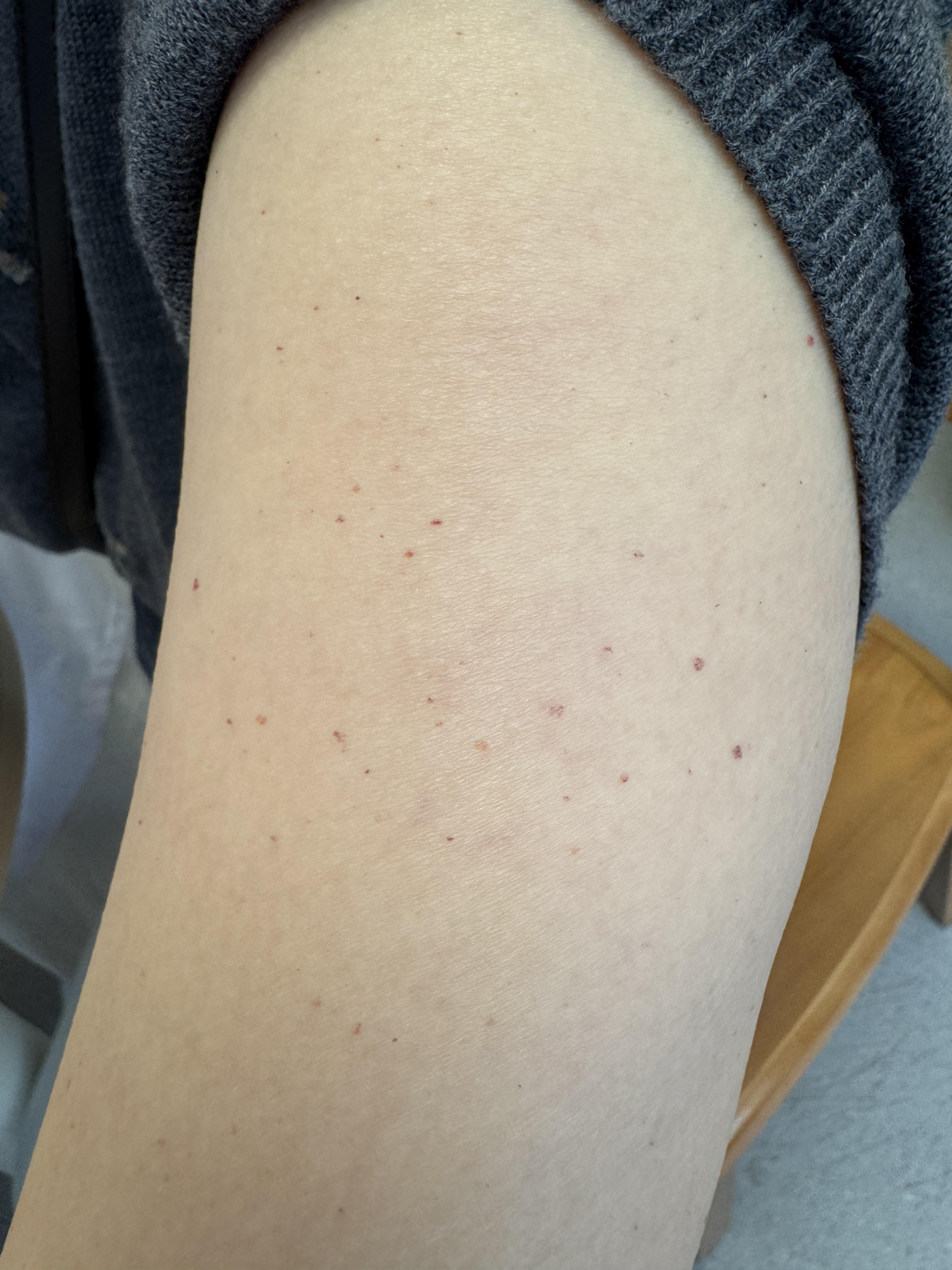 "长这种小红点,千万要当心