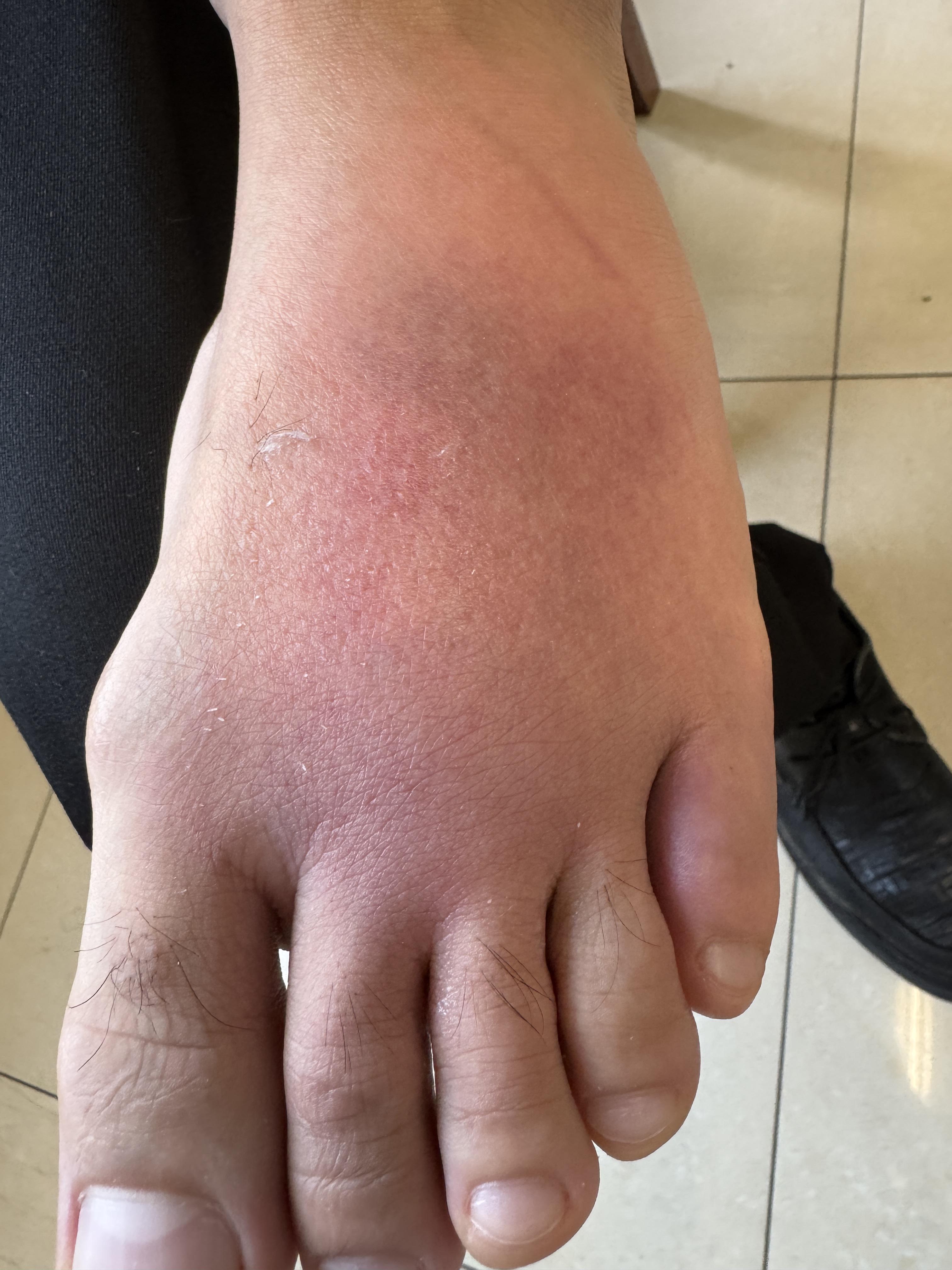 上足癣继发感染的倒不少从脚趾后方开始足背红肿热痛典型的急性炎症