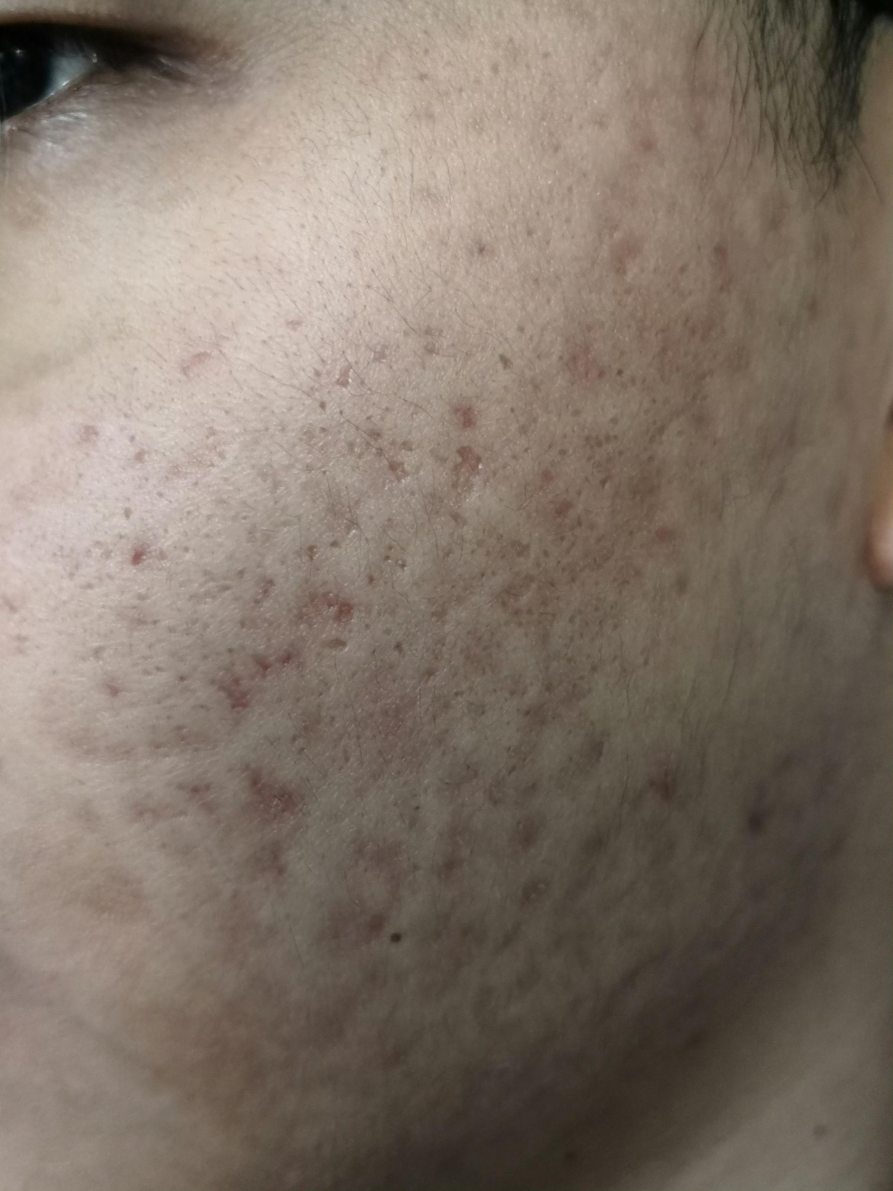 纪秀军主任医师 的想法: 痤疮痘坑痘印疤痕可以激光配合药物治疗