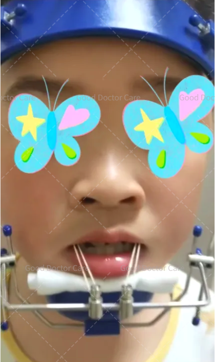 知乎用户belfvg 的想法: 初戴功能矫治器frank2