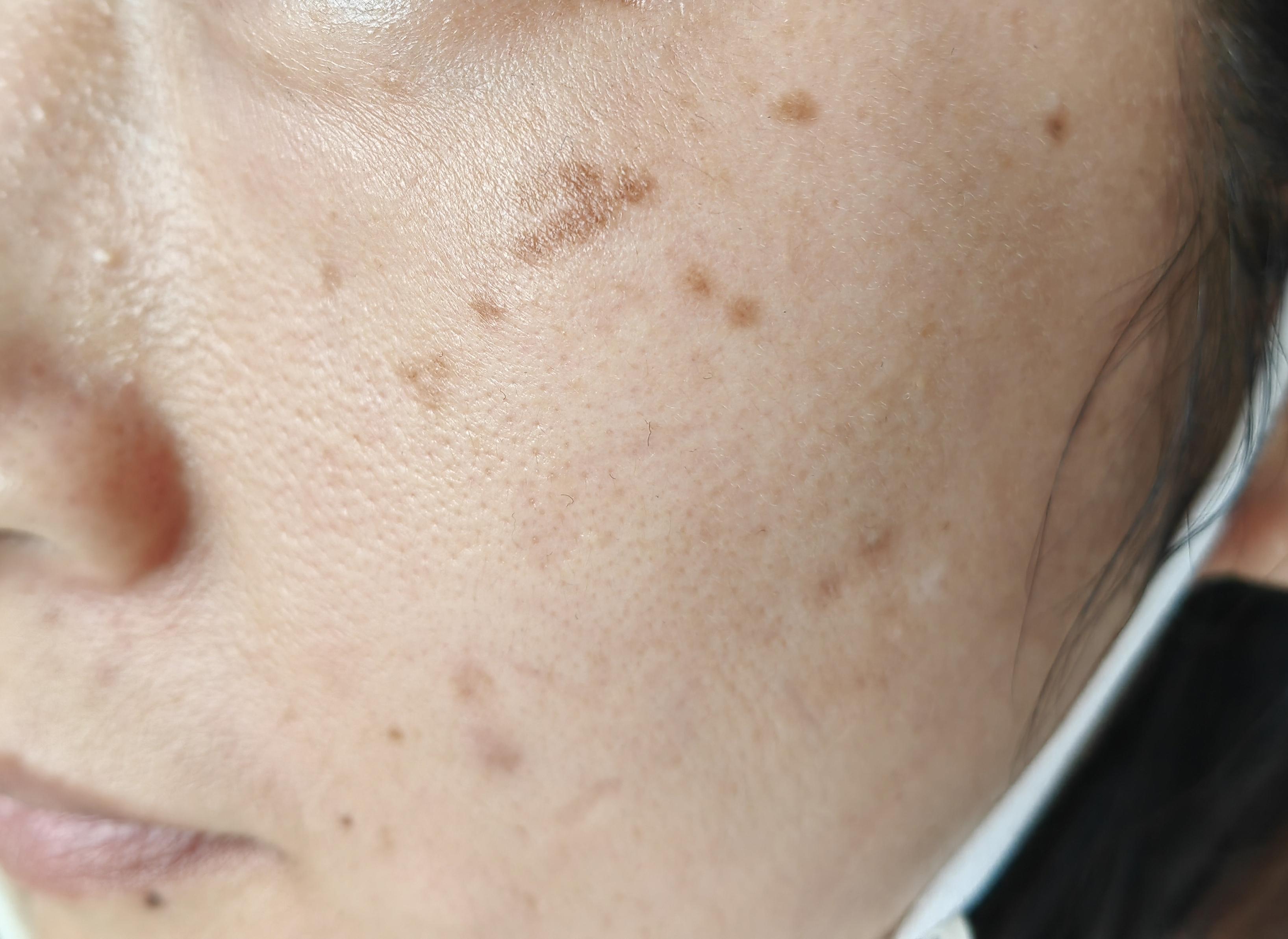 10年前分娩后脸上出现了色斑,虽然没啥不适感觉,但心里肯定不舒服