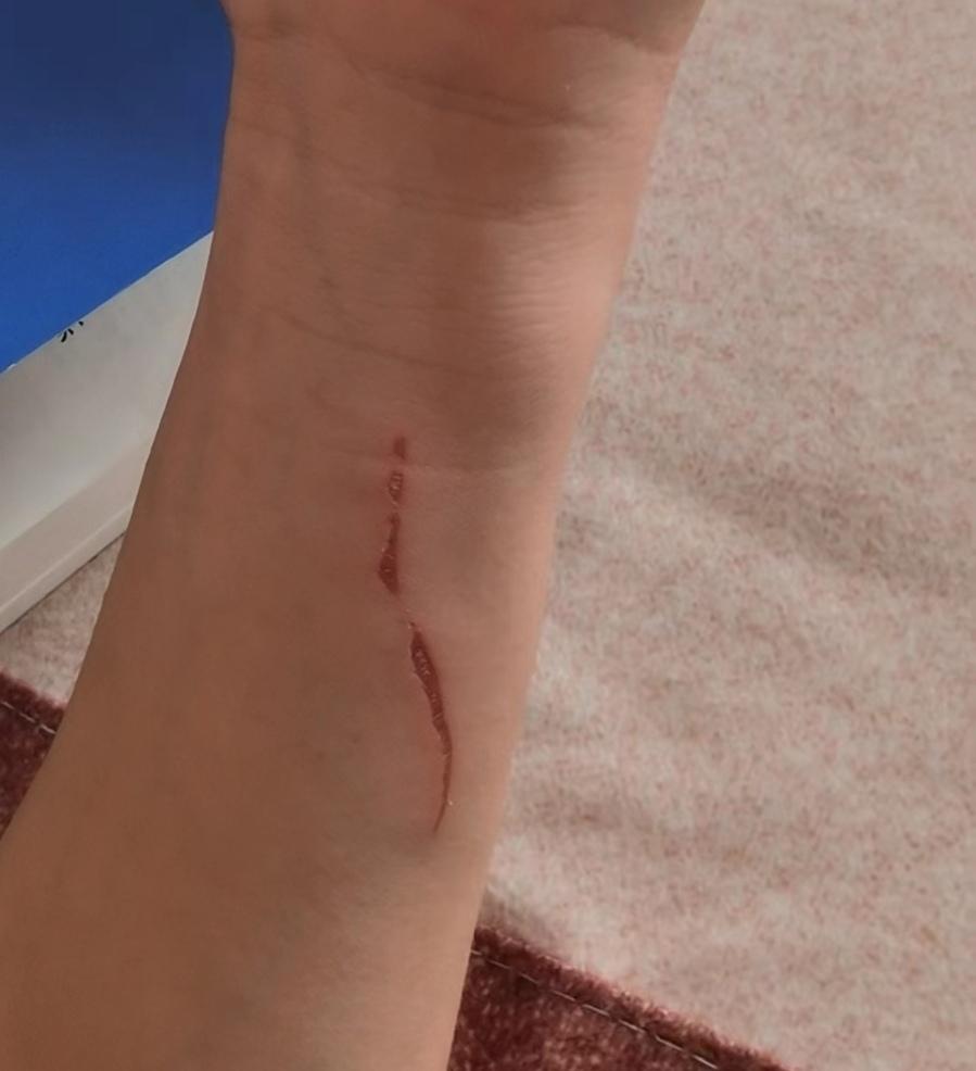 虎皮卷卷 的想法: 胳膊被指甲划伤,公安体检能过吗?