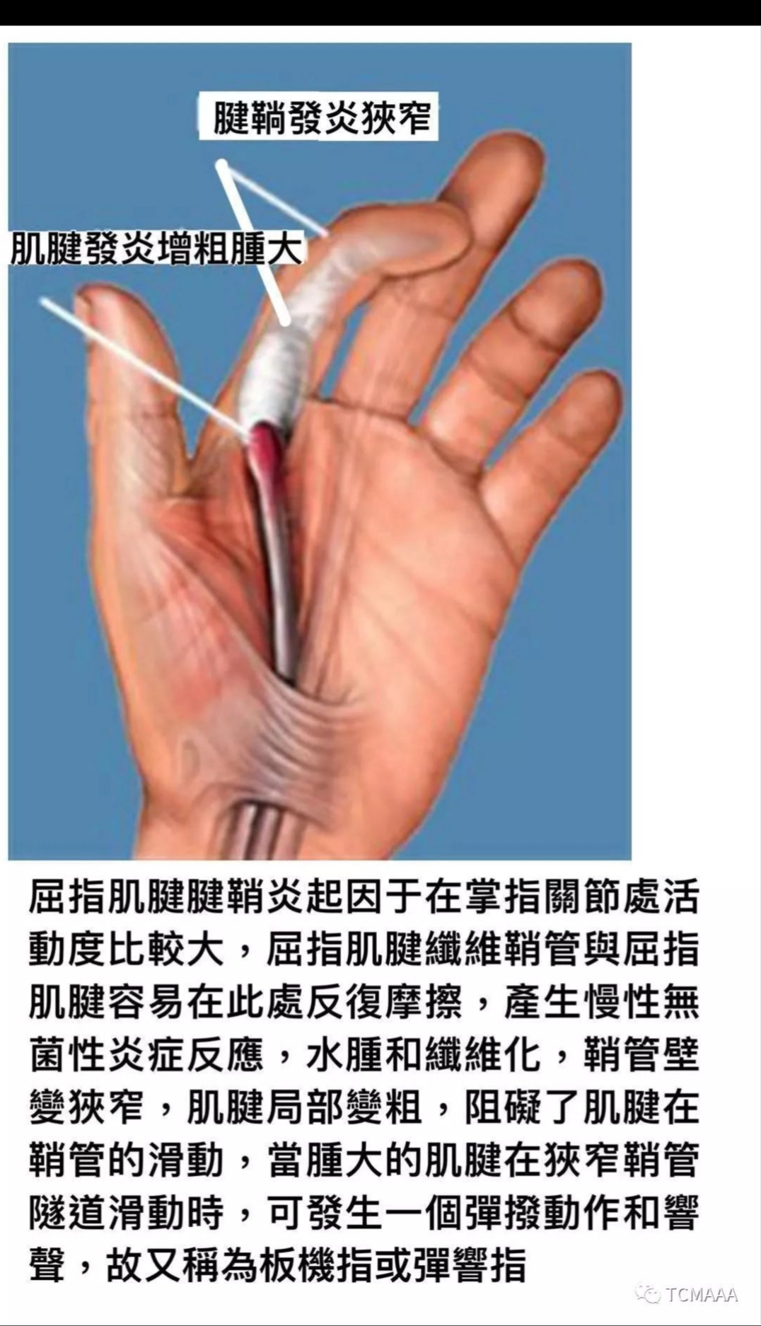 食指腱鞘炎几年前有一次扶墙不小心压了一下后来就肿了有时候隐隐作痛