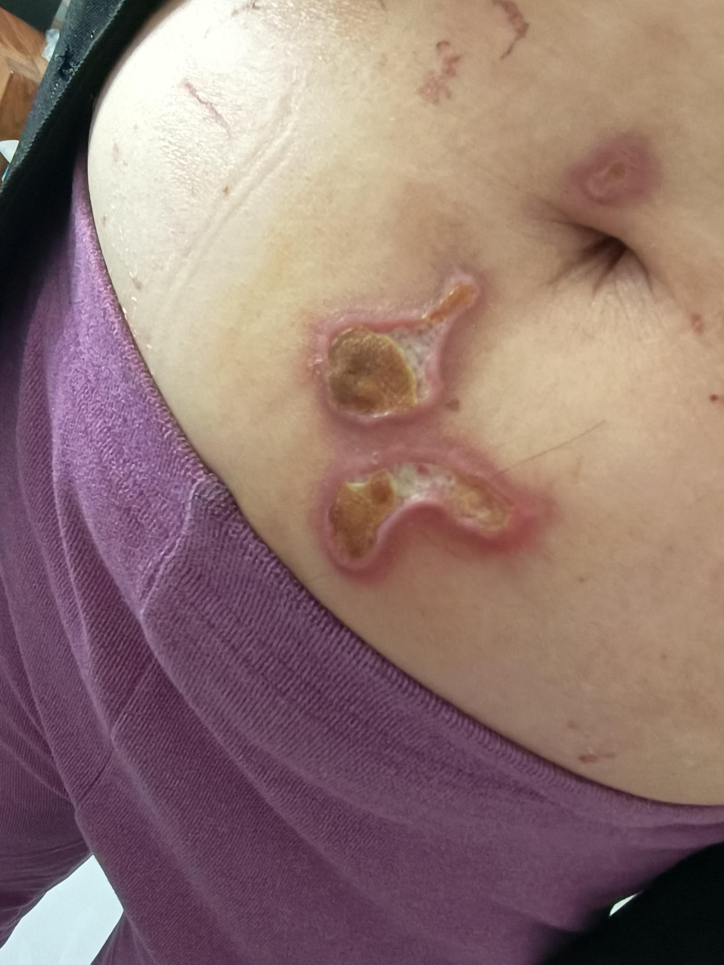 姆乔 的想法: 有没有比较专业的人知道,美容店烤艾灸后成这样是烫伤吗