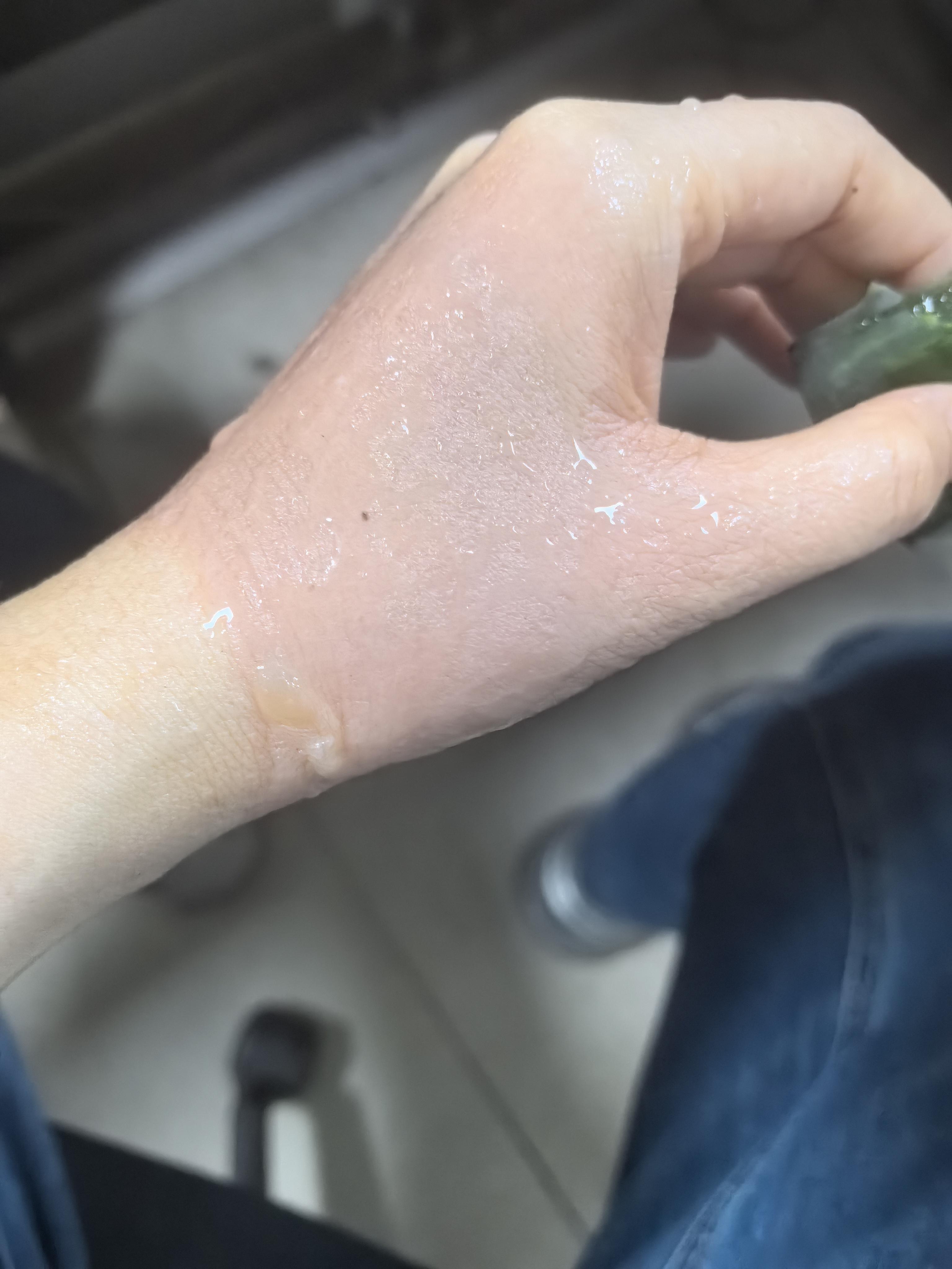 小半 的想法: 被开水烫伤后恢复历程