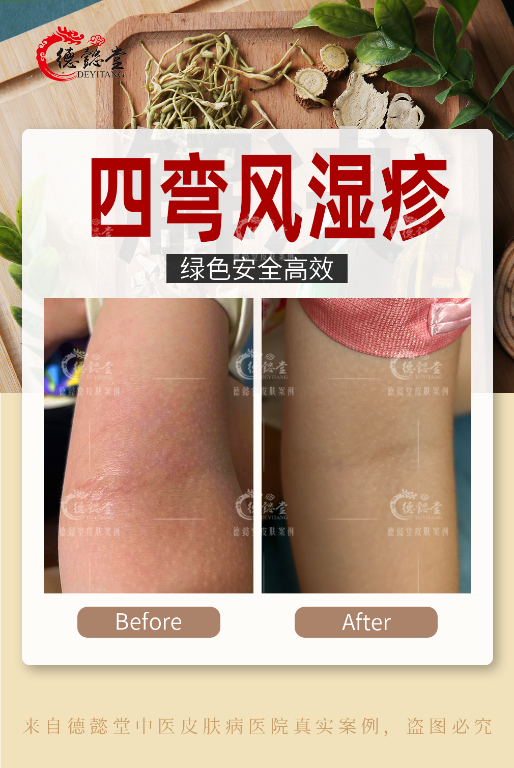 皮肤李志忠 的想法: 【湿疹(四弯风)】孩子湿疹瘙痒严重,用药两周有了