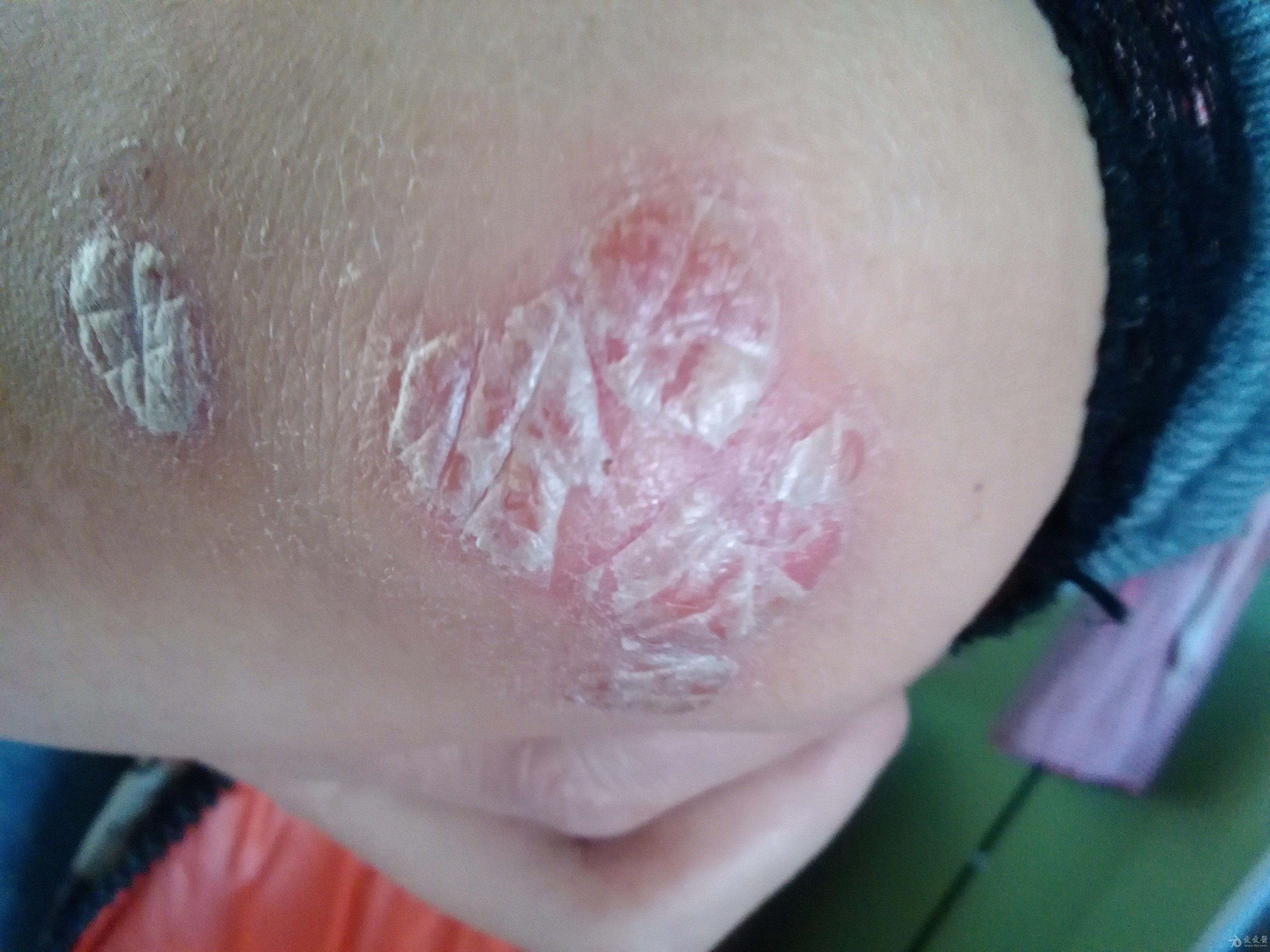 白癜风乐细高 的想法: 两侧胳膊肘都有,长图片这种