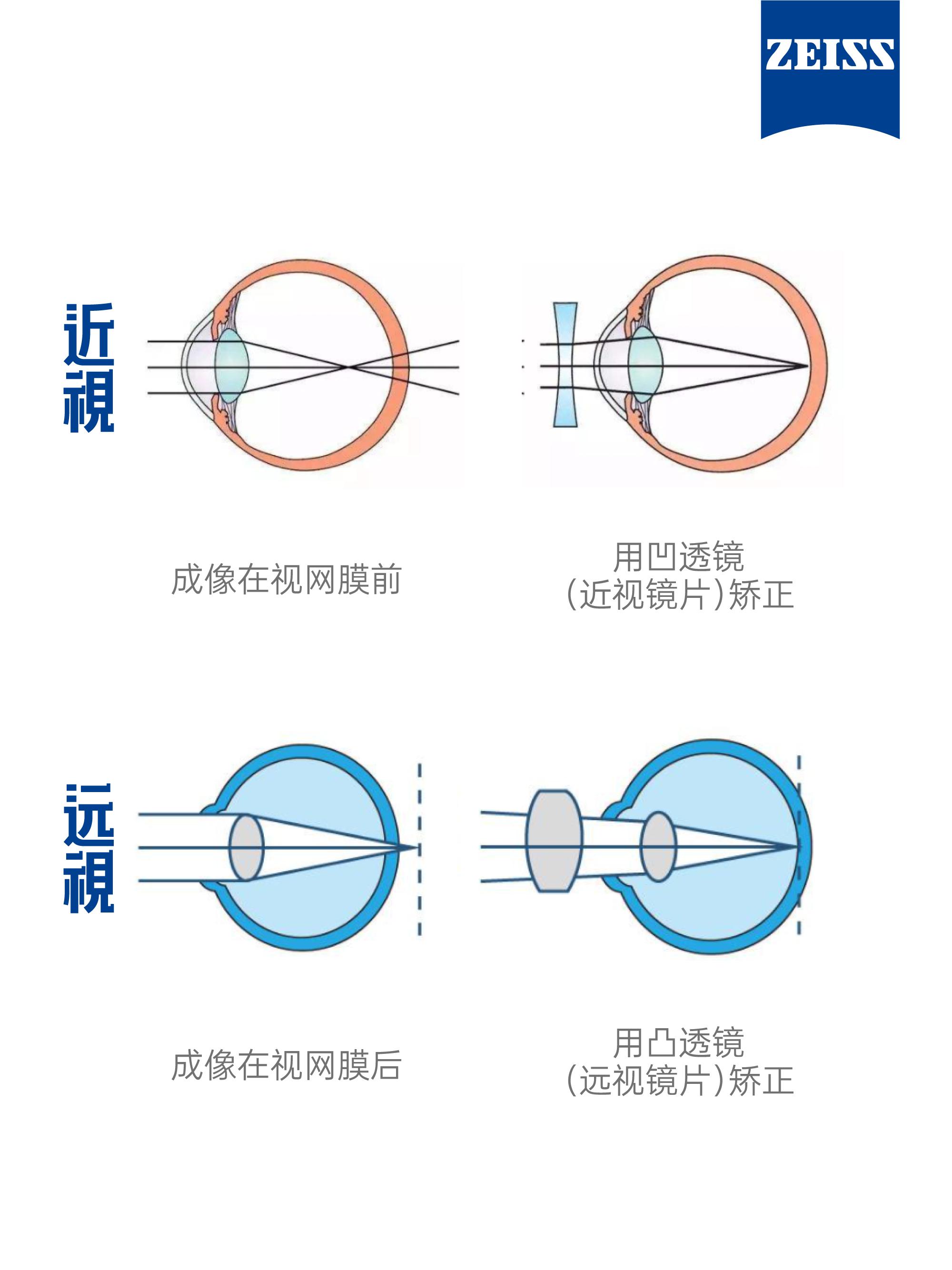 近视眼是由于外界平行光线,经过眼内屈光系统折射之后,不能准确的