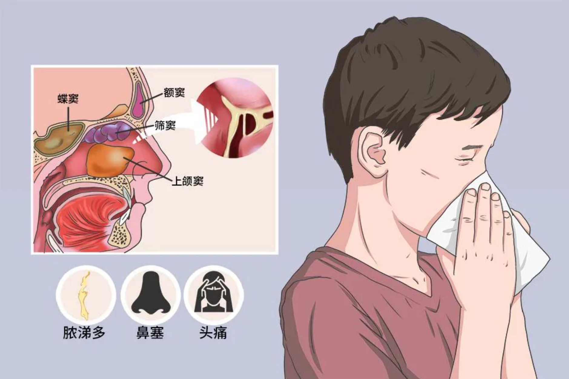 中發病率較高的疾病影響患者生活質量鼻竇炎可分為急性慢性鼻竇炎2種