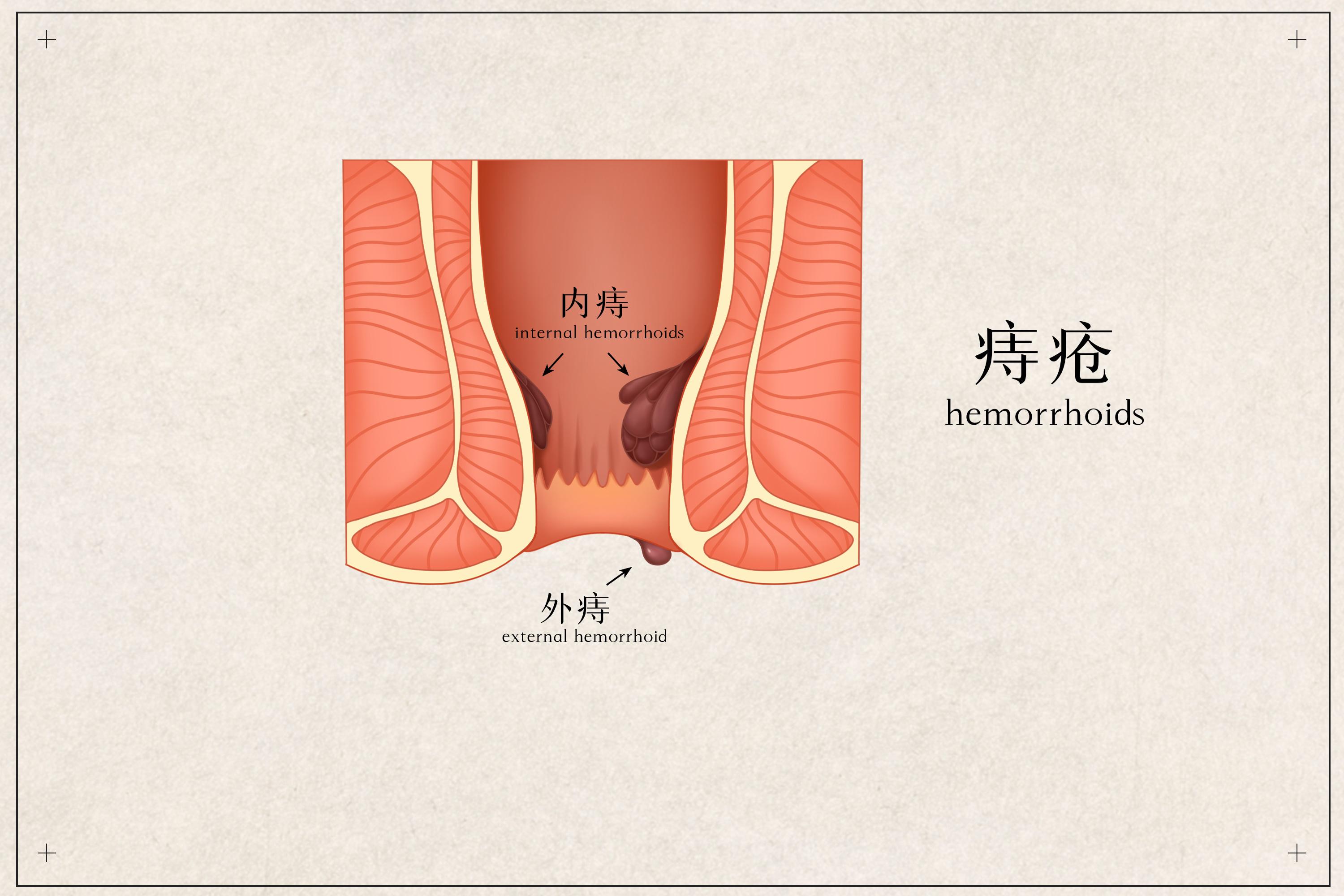 女的看痔疮挂哪个科的号（女性痔疮应该挂什么科有女大夫
）《女士看痔疮挂什么科》