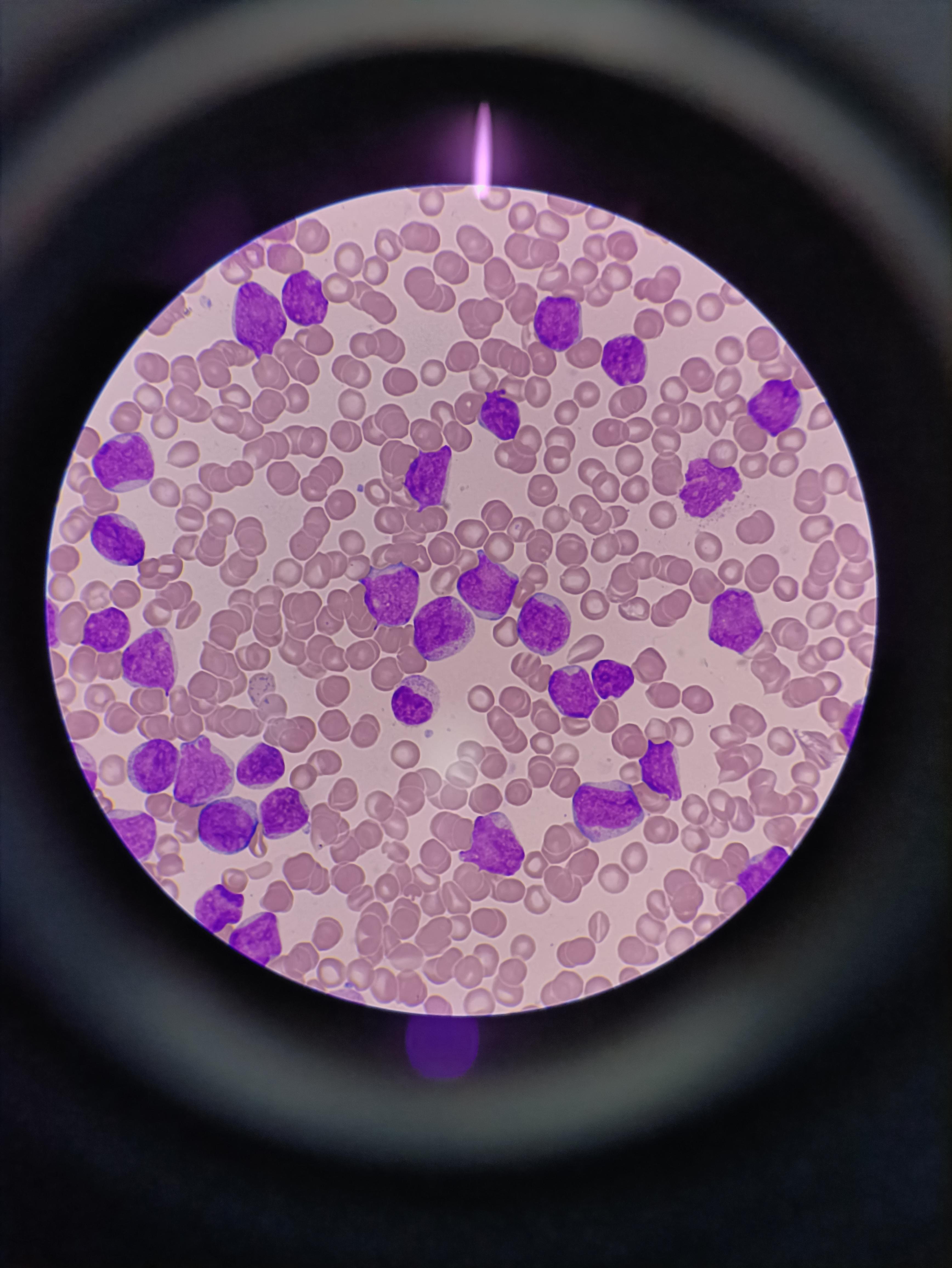 白细胞计数:236×10的9次方每升