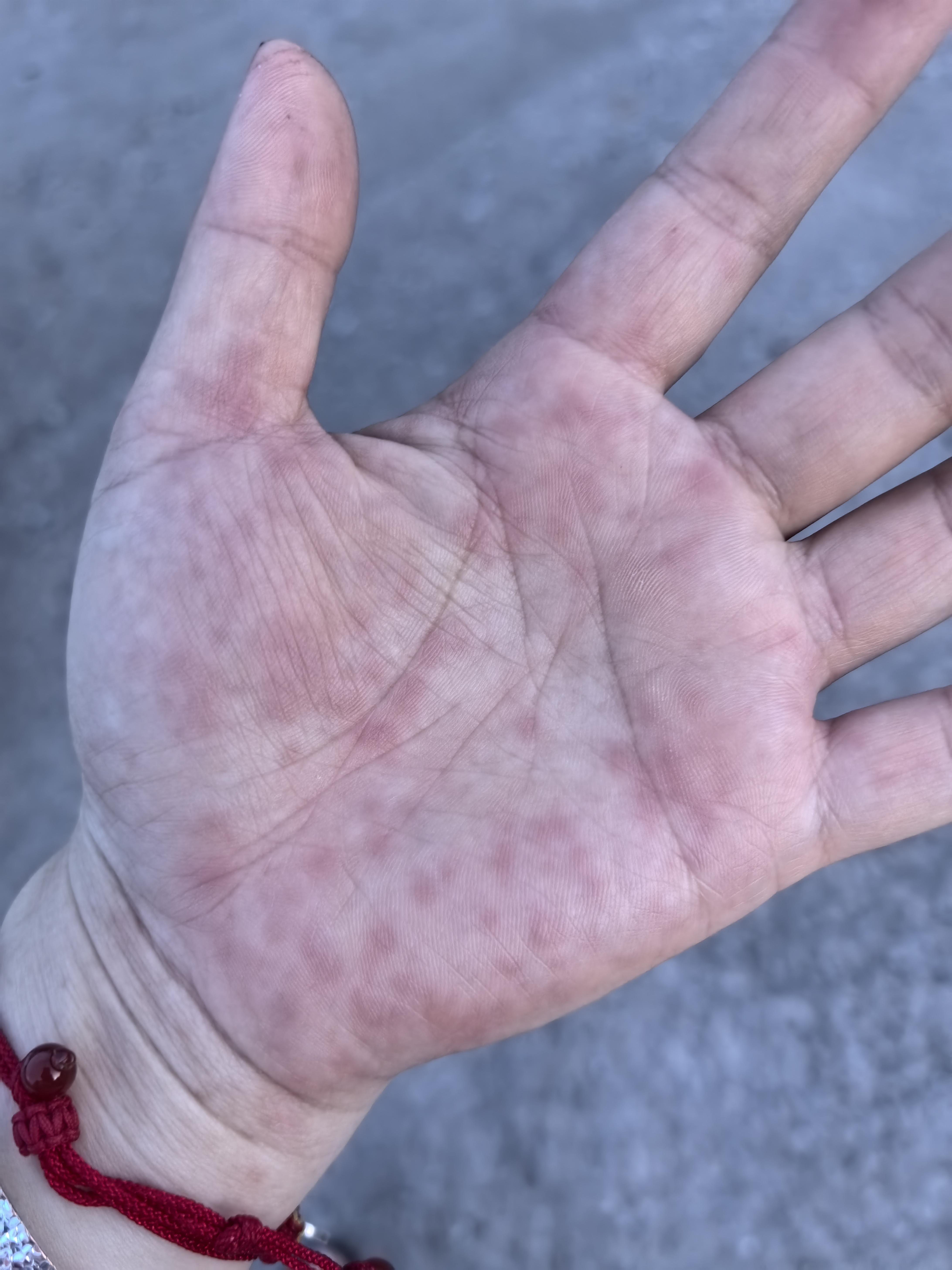 糯米 的想法: 手心脚底红点奇痒,查不出异常