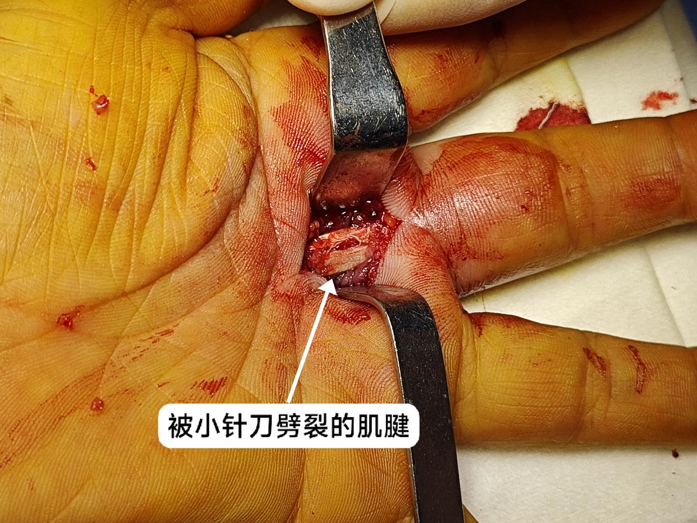 小针刀治疗腱鞘炎简析一个失败的病例腱鞘炎是临床中常见的疾病就是