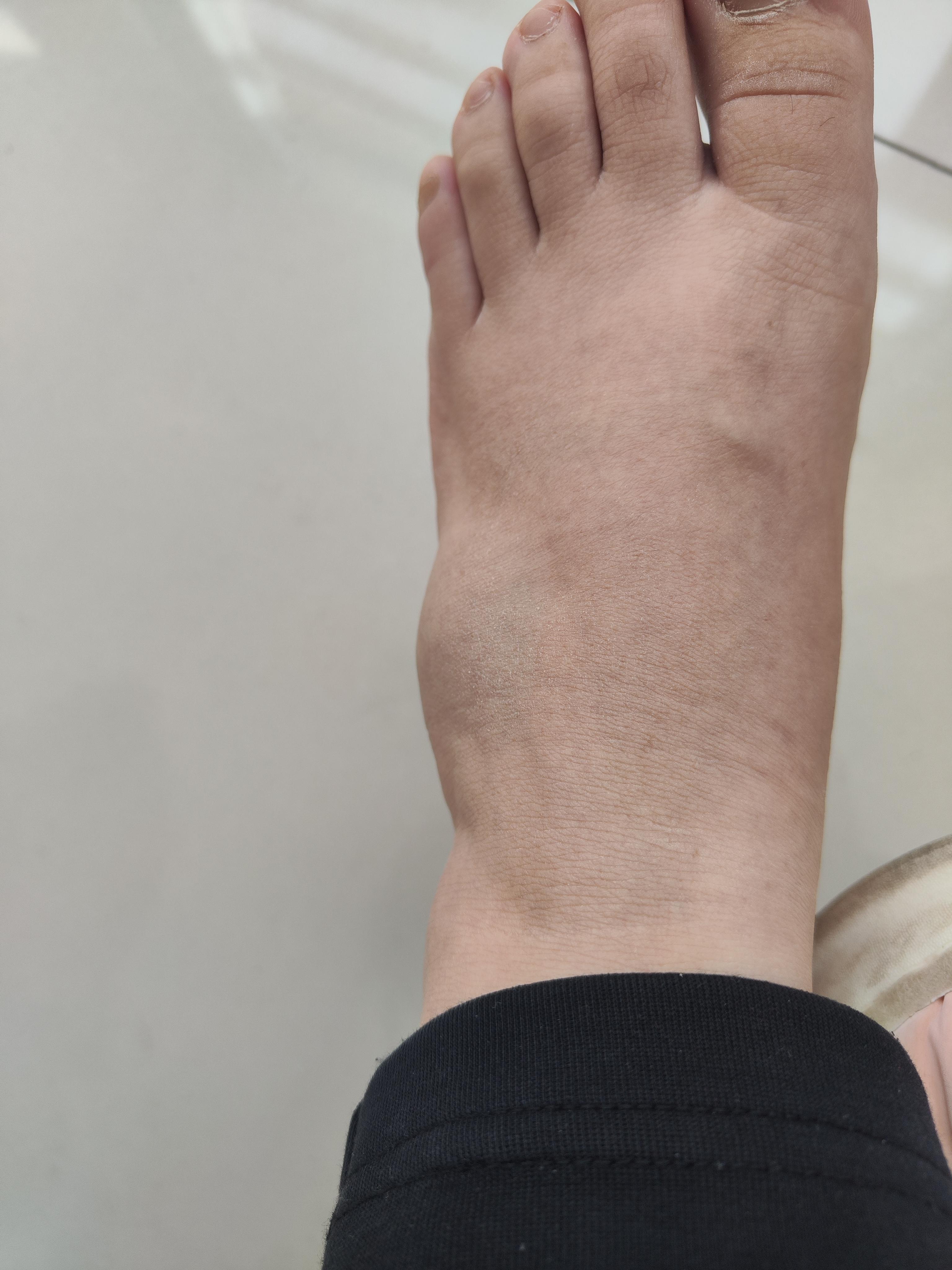 木与子 的想法: 记录左脚骨折全过程