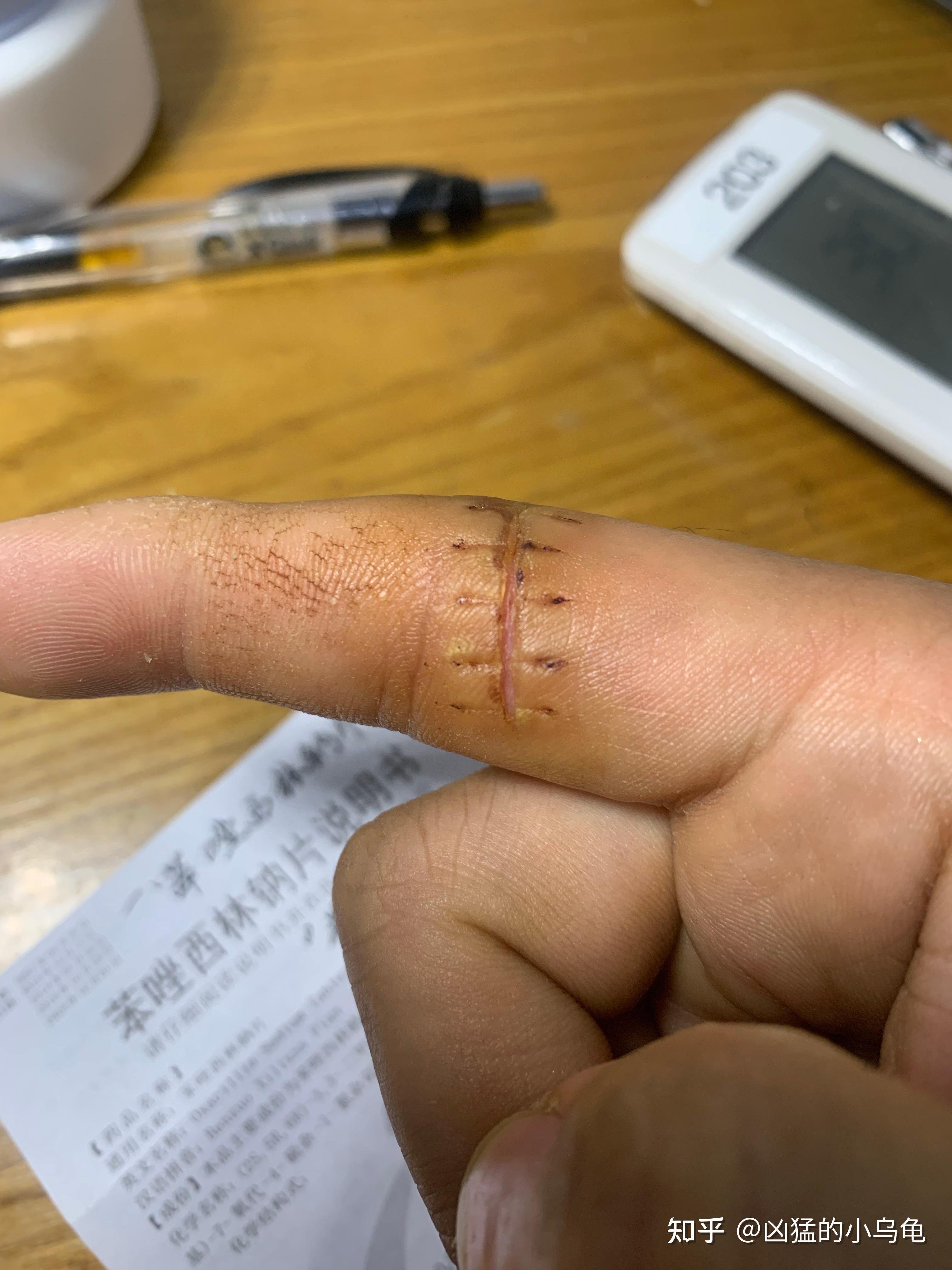 03-10 2246​小可爱这样算是拆线后伤口裂开了么?