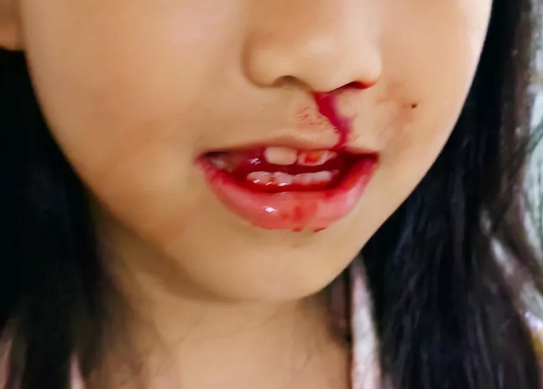 深麟堂 的想法: 流鼻血,中医称之为"鼻衄",是常见的症状