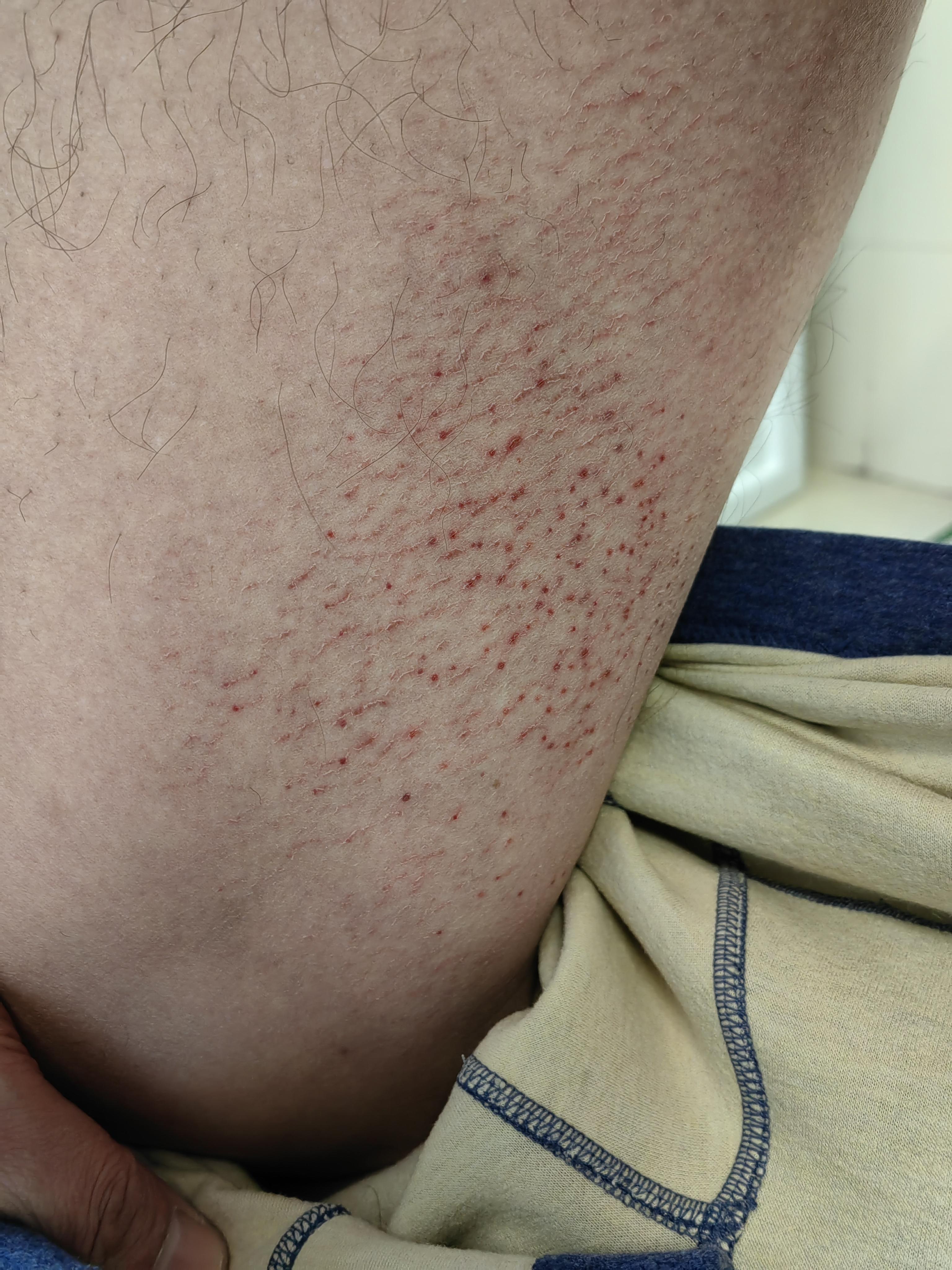护肤在西塘 的想法 大腿内侧干裂疼痛为哪般?