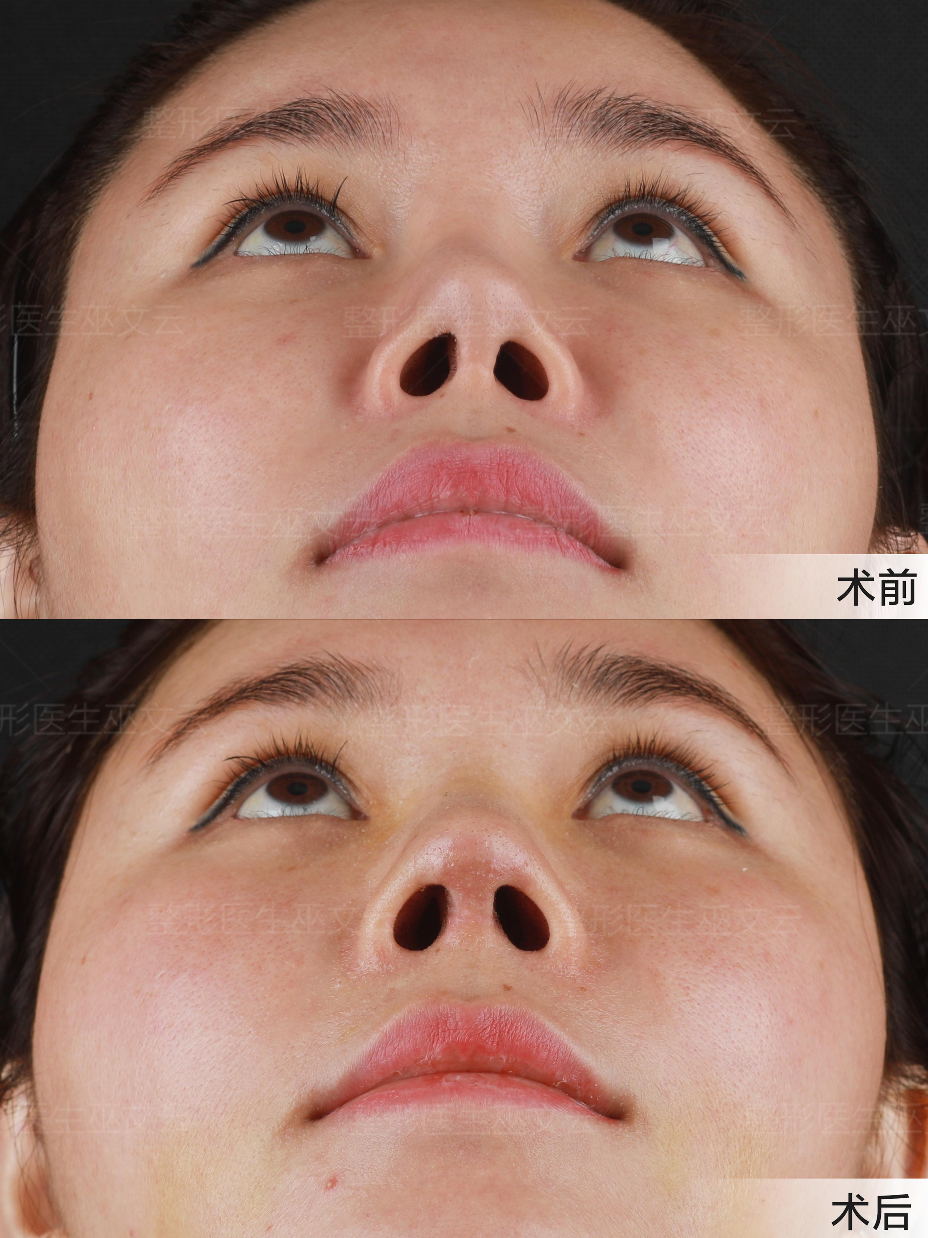 整形医生巫文云 的想法: 多次手术后的鼻挛缩,处理原则探讨