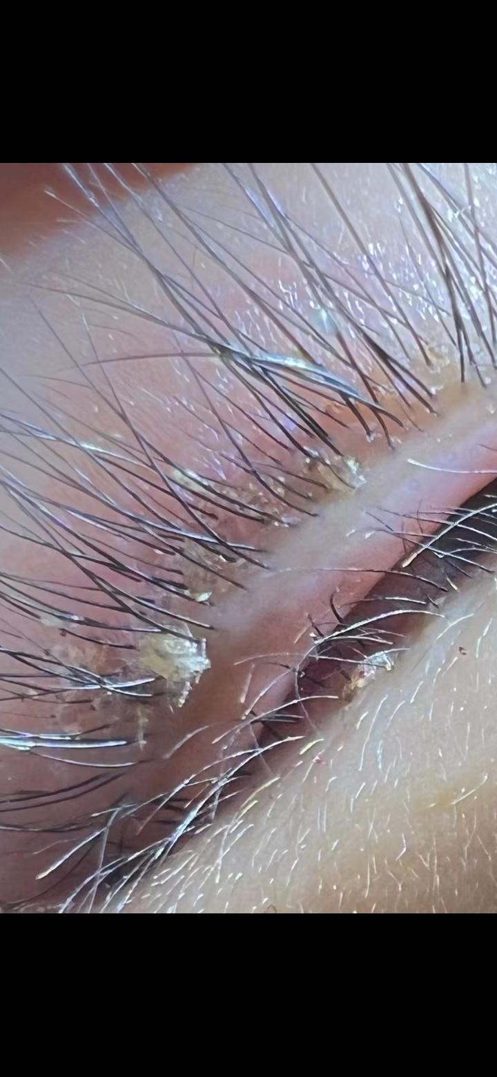 阿彬 的想法: 阴虱,跑到睫毛上,引起眼痒不适!