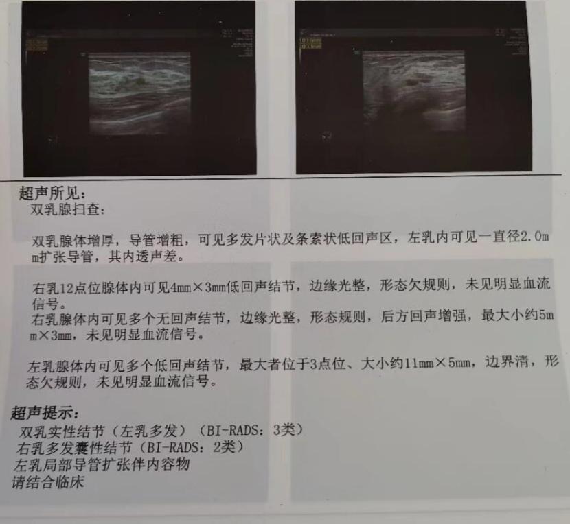 帮忙看看乳腺钼靶结果