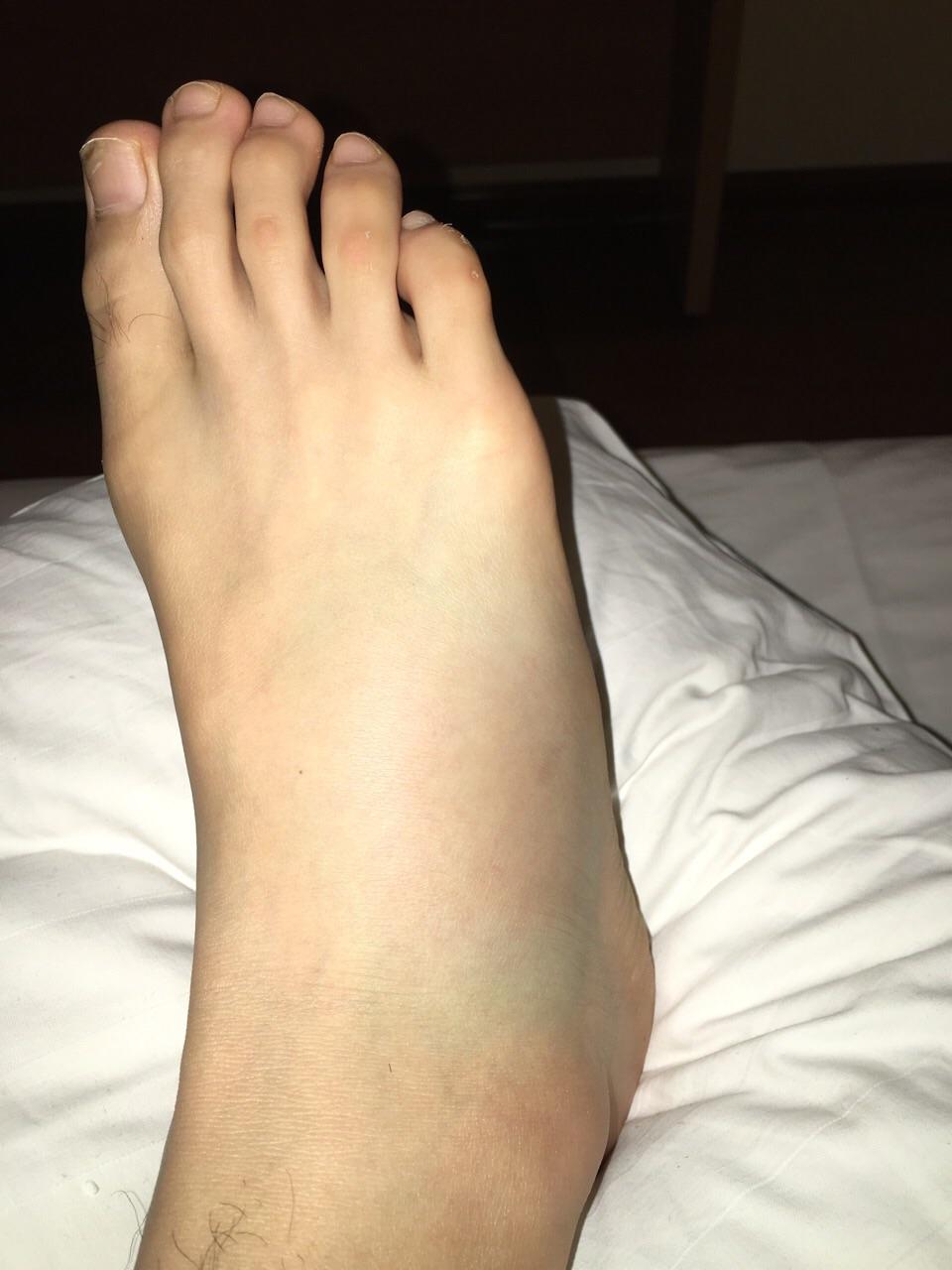 崴一脚骨折的可能性大么?