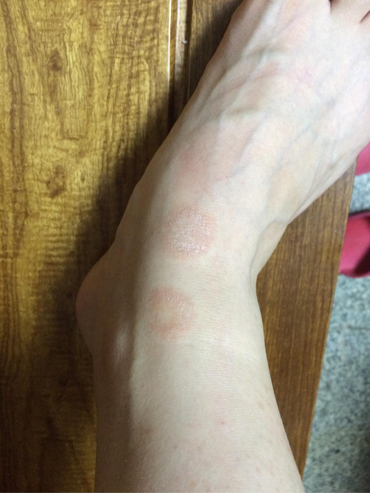 脚背上无意间长了癣,痒的不行,怎么办? - 知乎