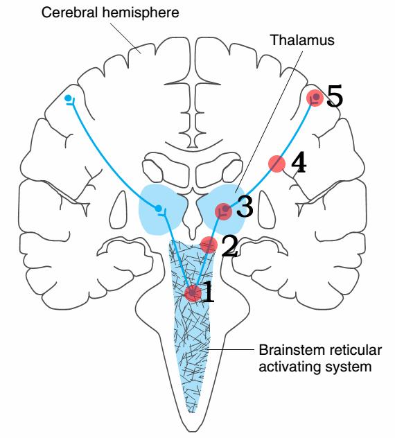 植物人是如何导致的