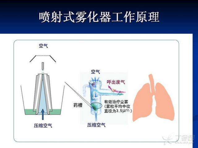 雾化治疗是怎么一回事? - 知乎