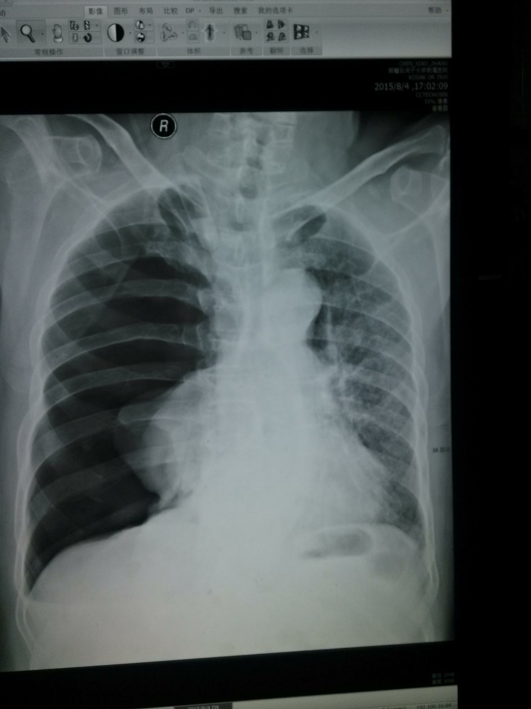 肺实质结节或肿块病灶，53张影像汇集！│以影识病_肺实质结节_肿块_影像_医脉通
