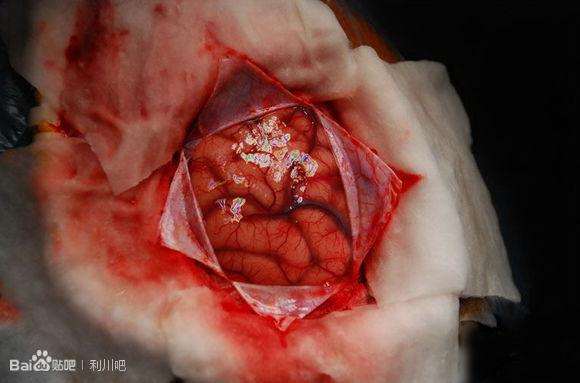 开颅手术的全部流程是怎样的