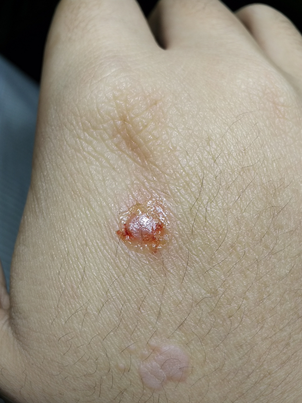 手背上这个东西是扁平疣吗我该怎么办