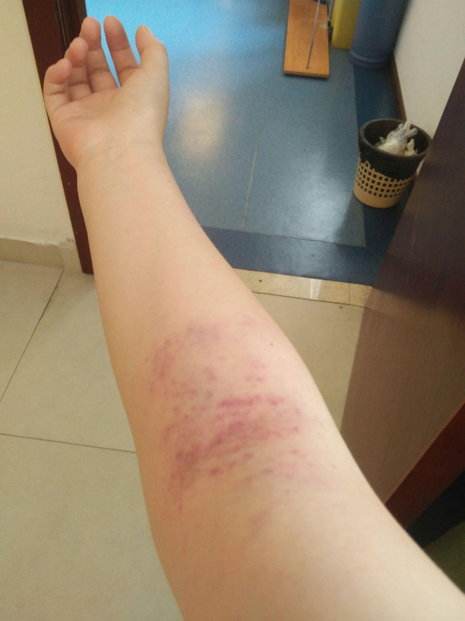 拍痧时如何知道拍出的是痧还是皮下出血