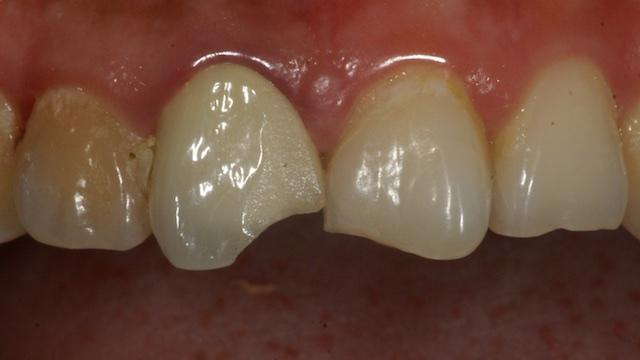 一颗门牙做过根管治疗脆弱不白要不要拔掉它换假牙呢如果洗牙会伤害它