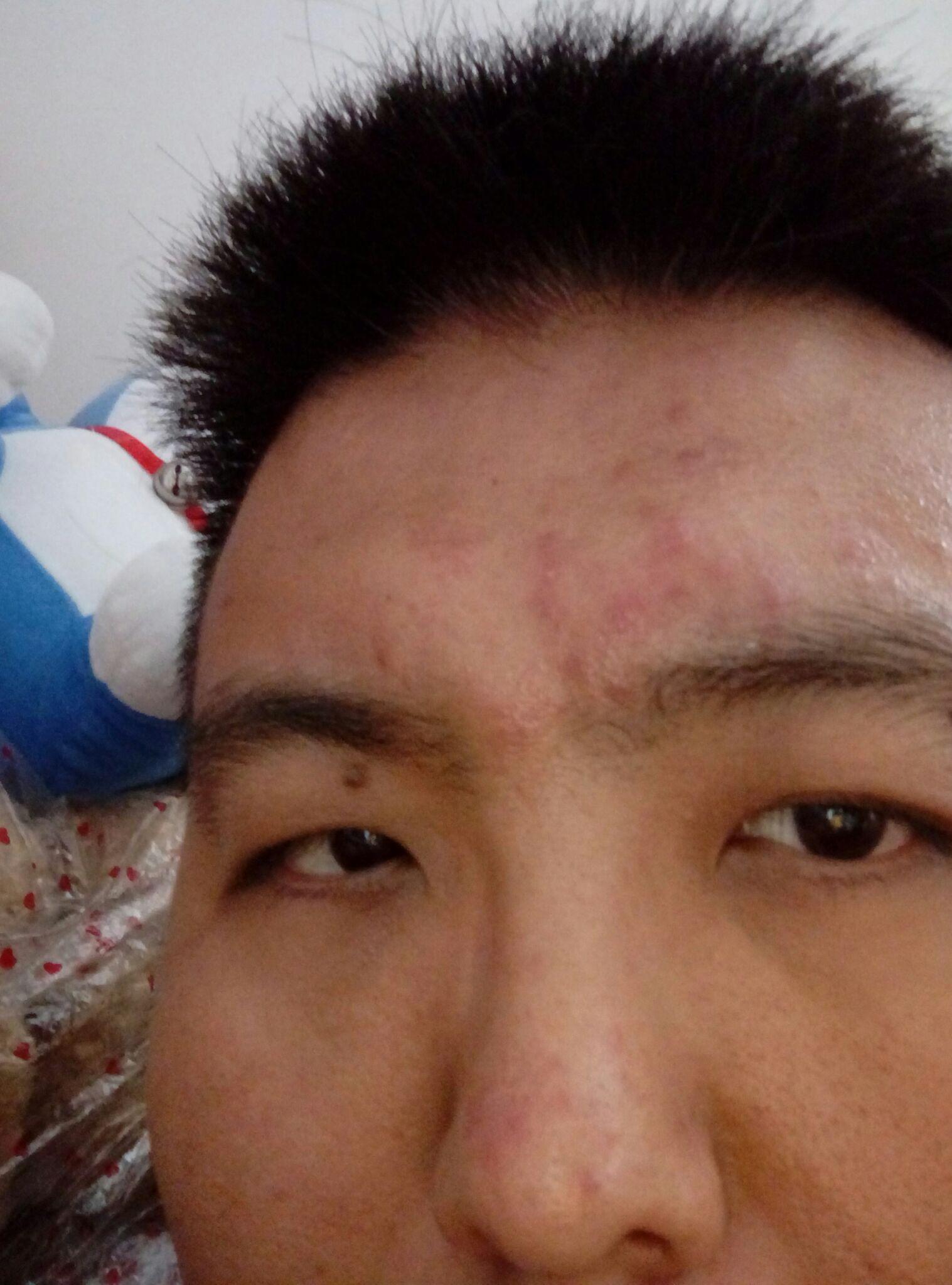 朋友脸上张的红疙瘩痒不疼有知道这是什么病的吗