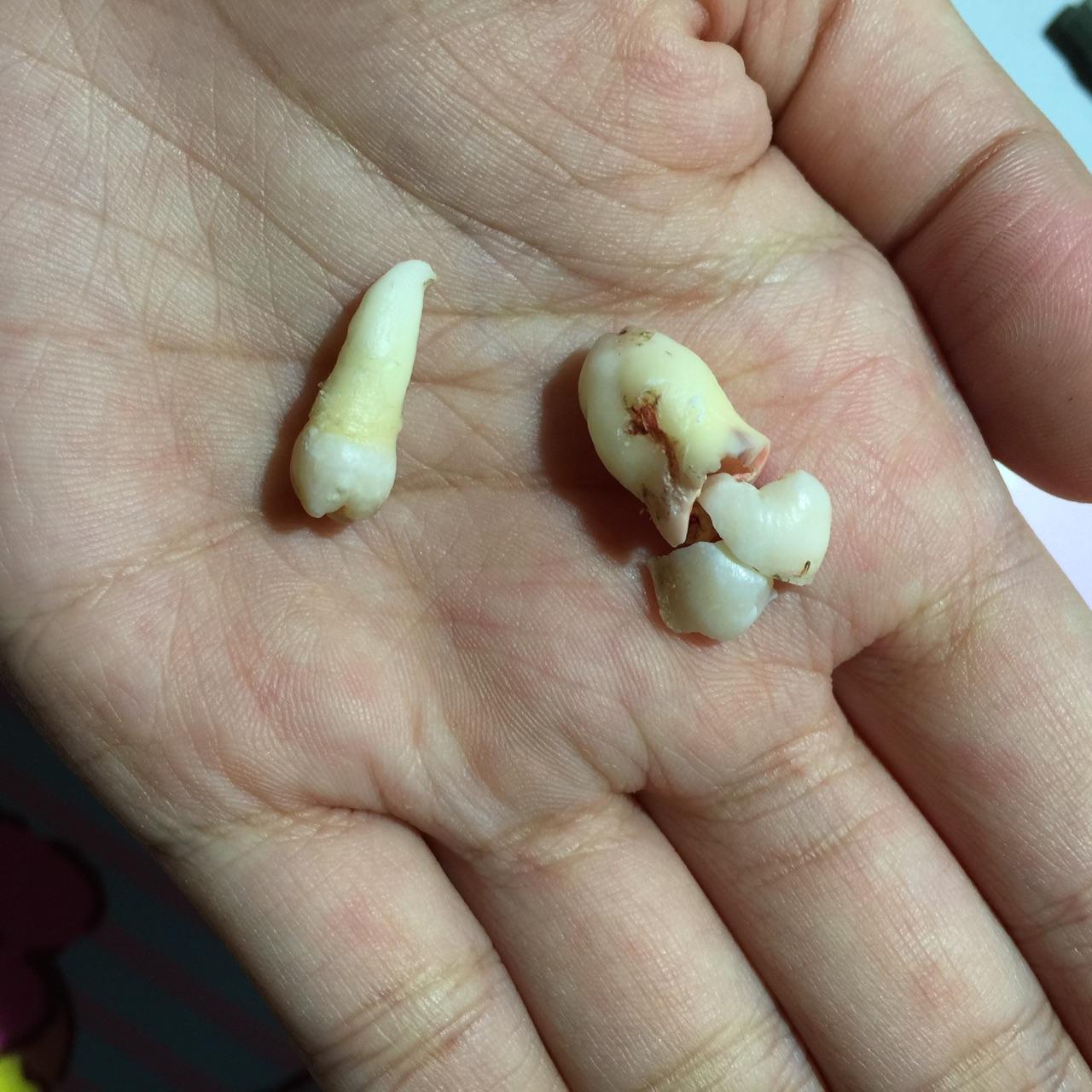拔下来的牙齿的归属权是病人的吗? 