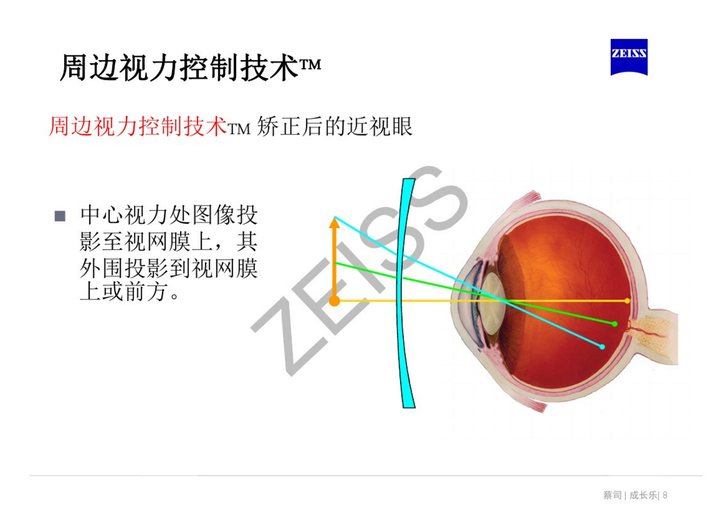 离焦镜是什么原理,真的可以缓解近视吗? - 知乎