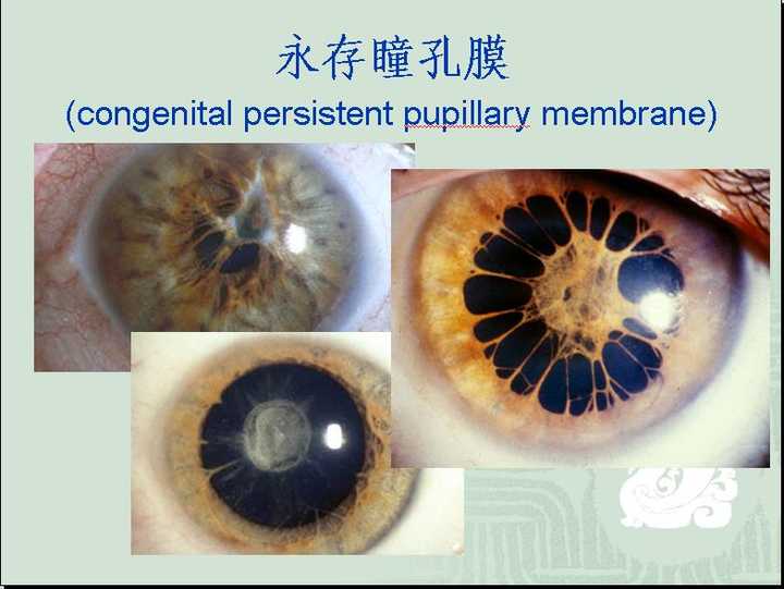 历史上的重瞳子是真实存在的吗?两个瞳仁在眼睛里是如何分布的? - 知乎